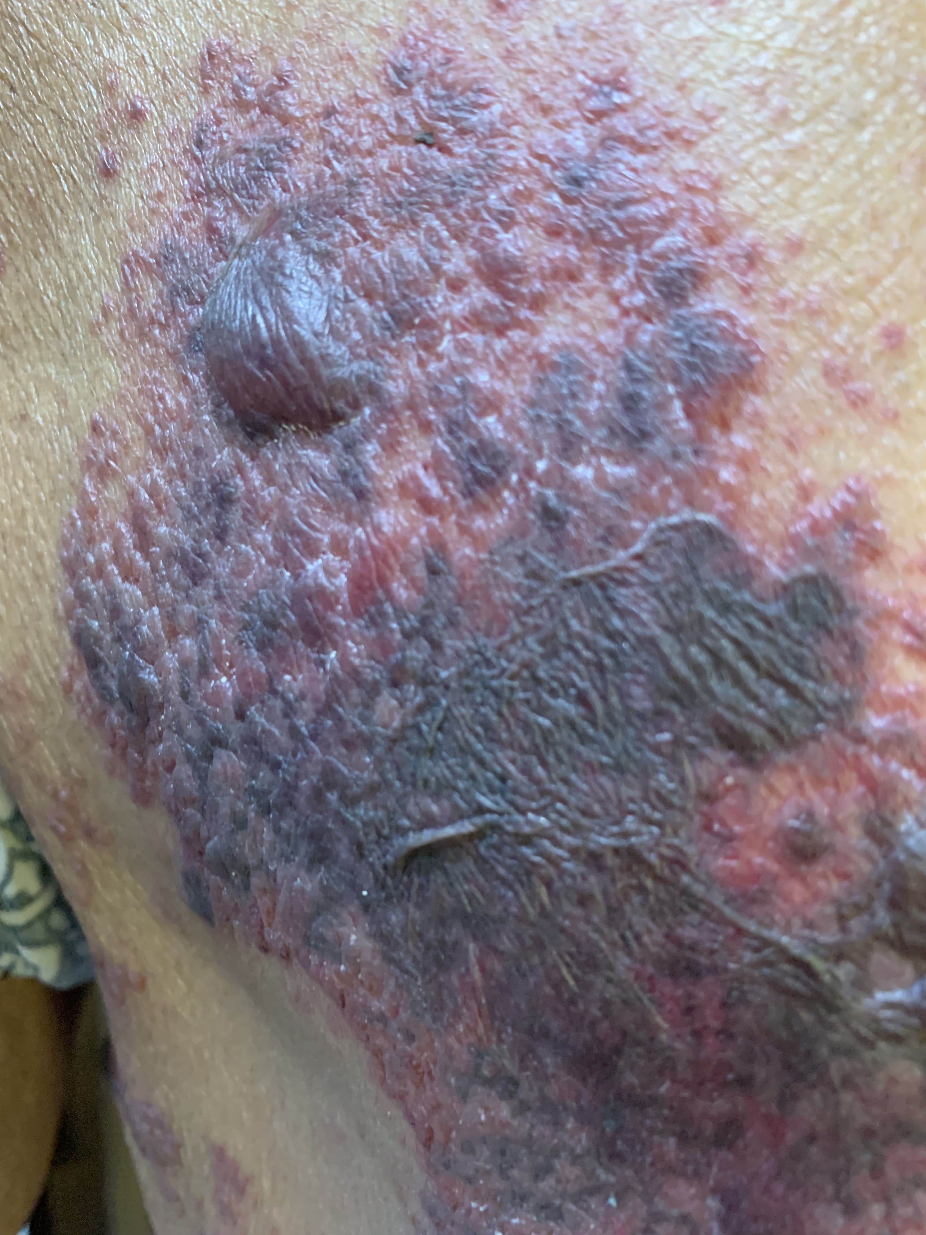 HERPES ZOSTER HEMORRAGICO