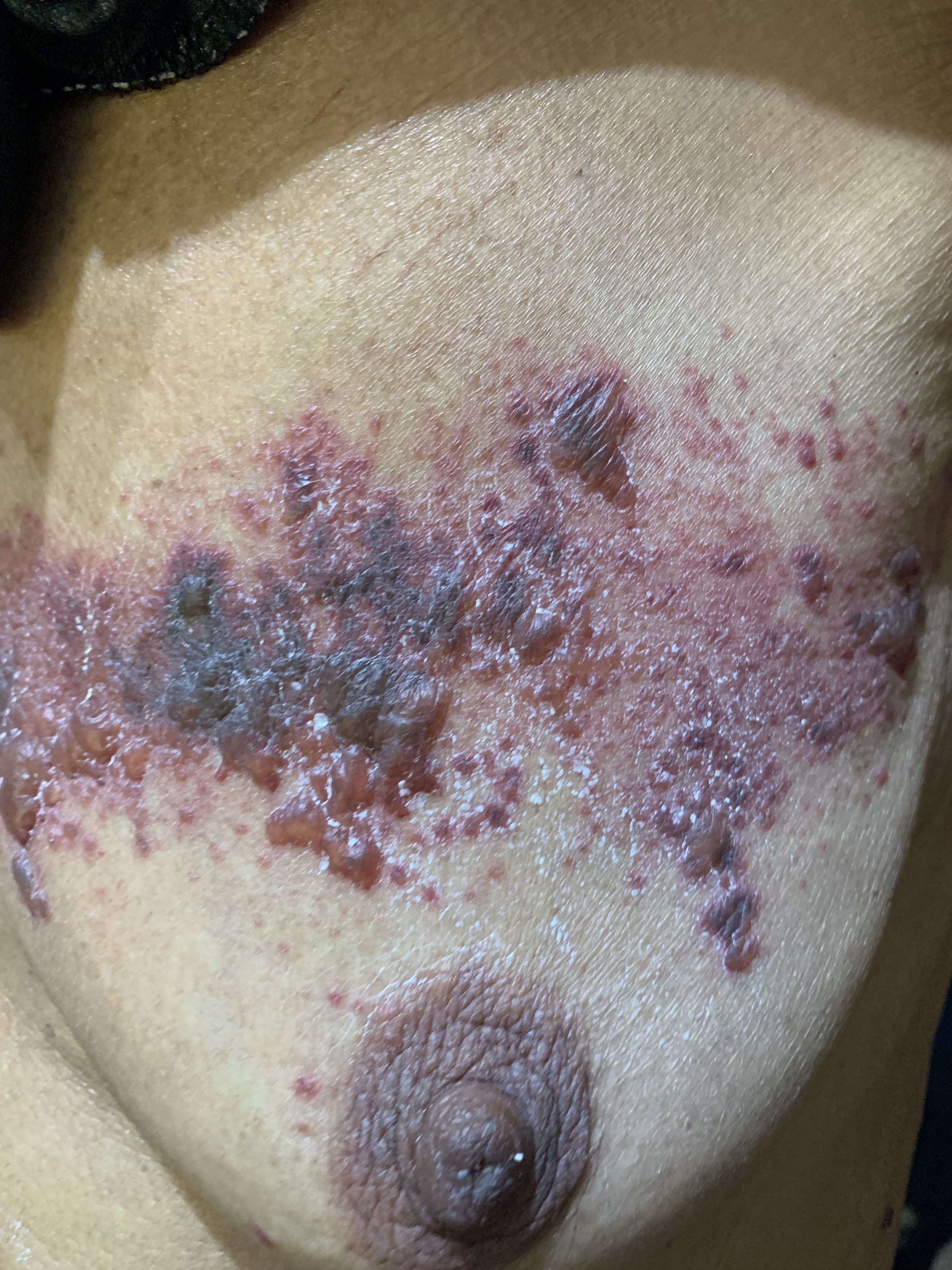 HERPES ZOSTER HEMORRAGICO