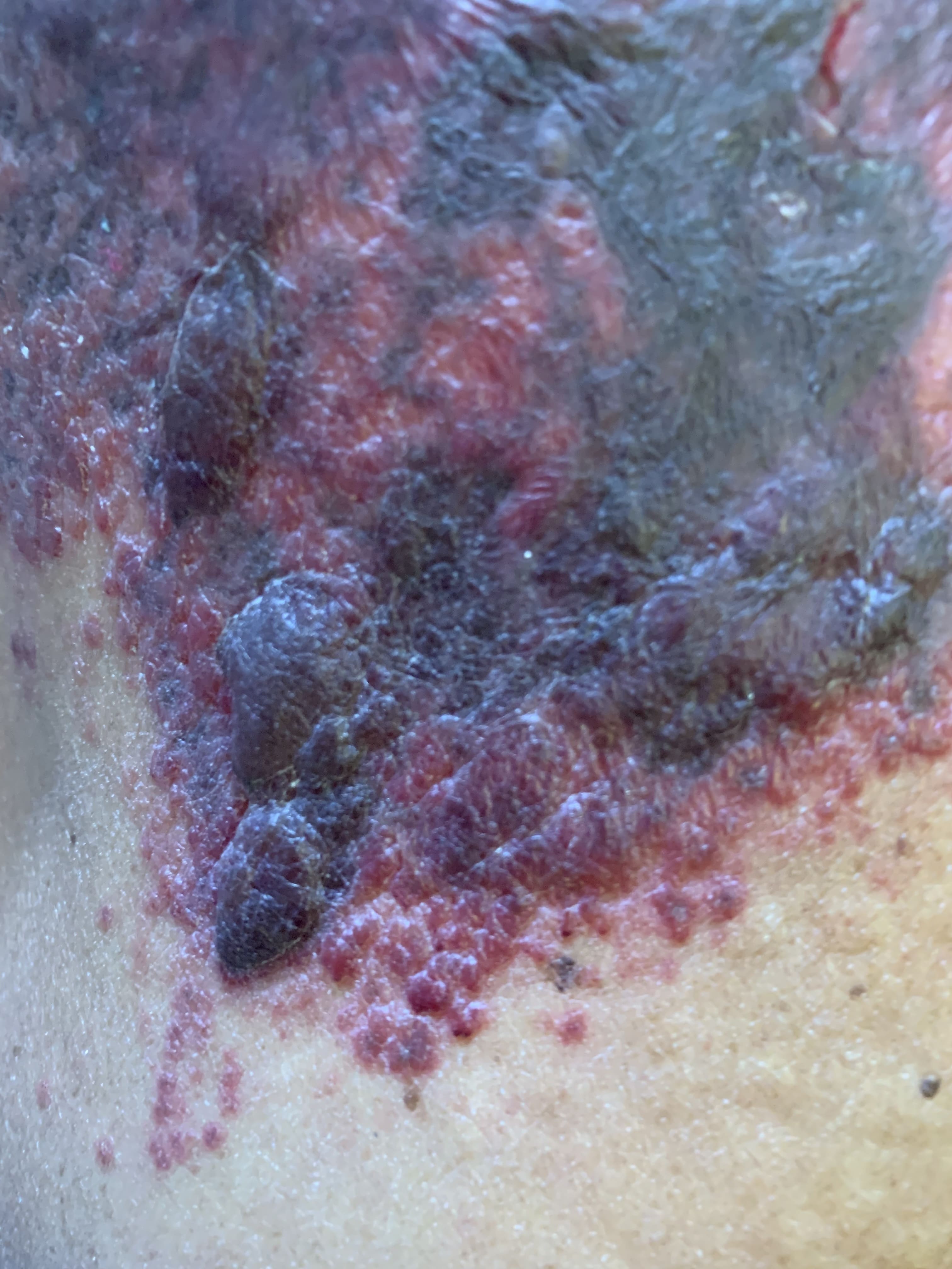 HERPES ZOSTER HEMORRAGICO