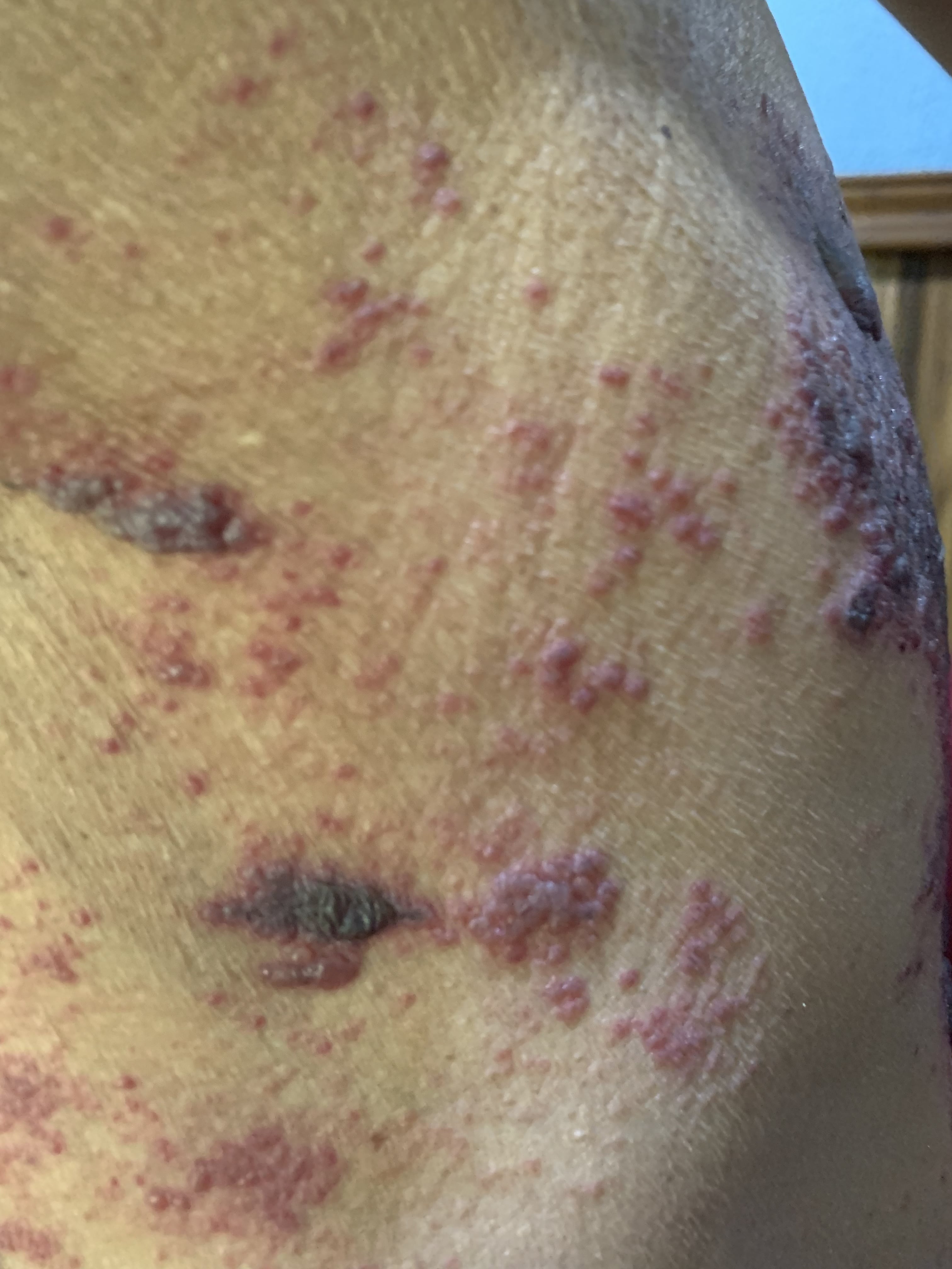 HERPES ZOSTER HEMORRAGICO