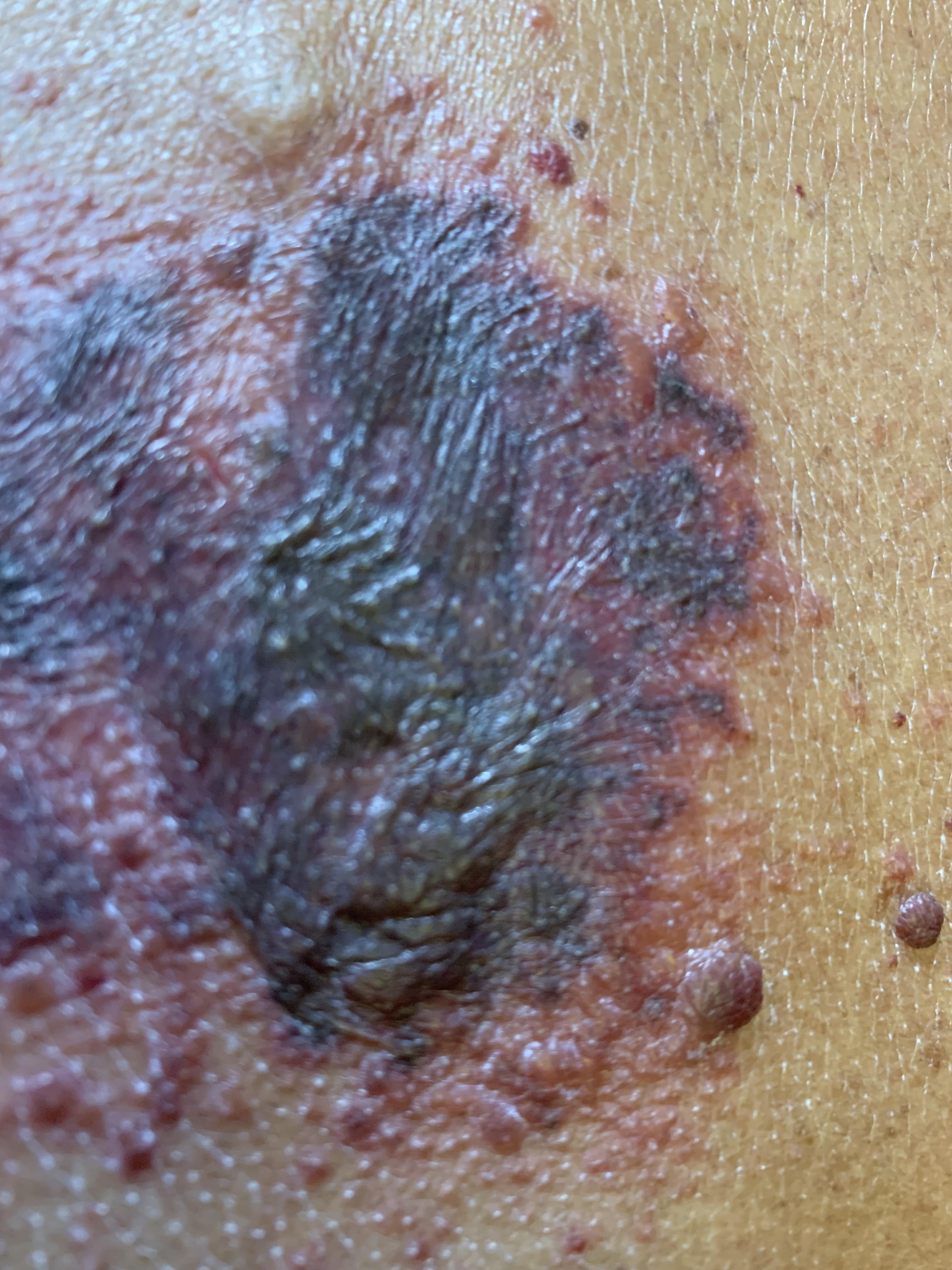 HERPES ZOSTER HEMORRAGICO