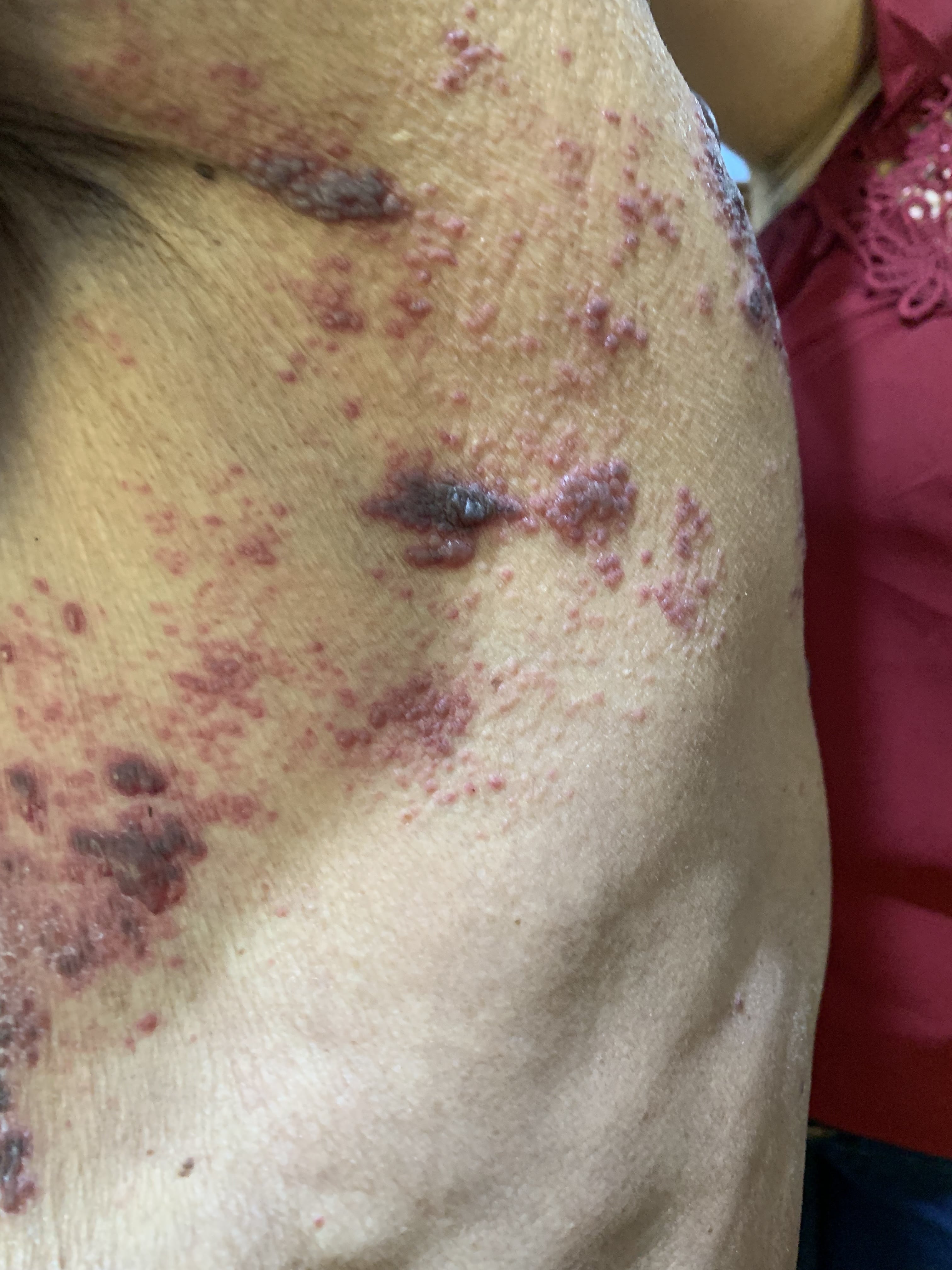 HERPES ZOSTER HEMORRAGICO