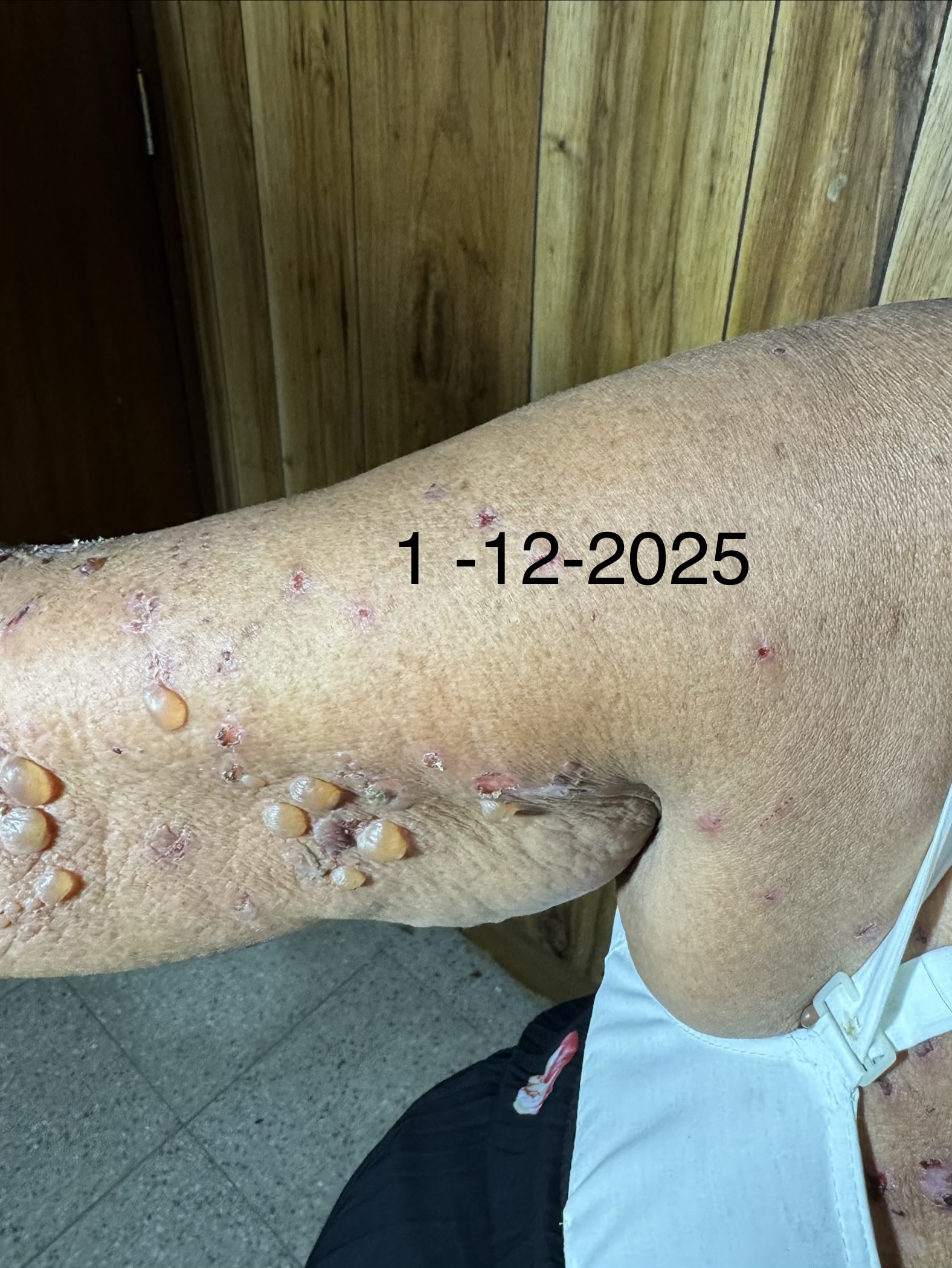 PENFIGOIDE AMPOLLOSO