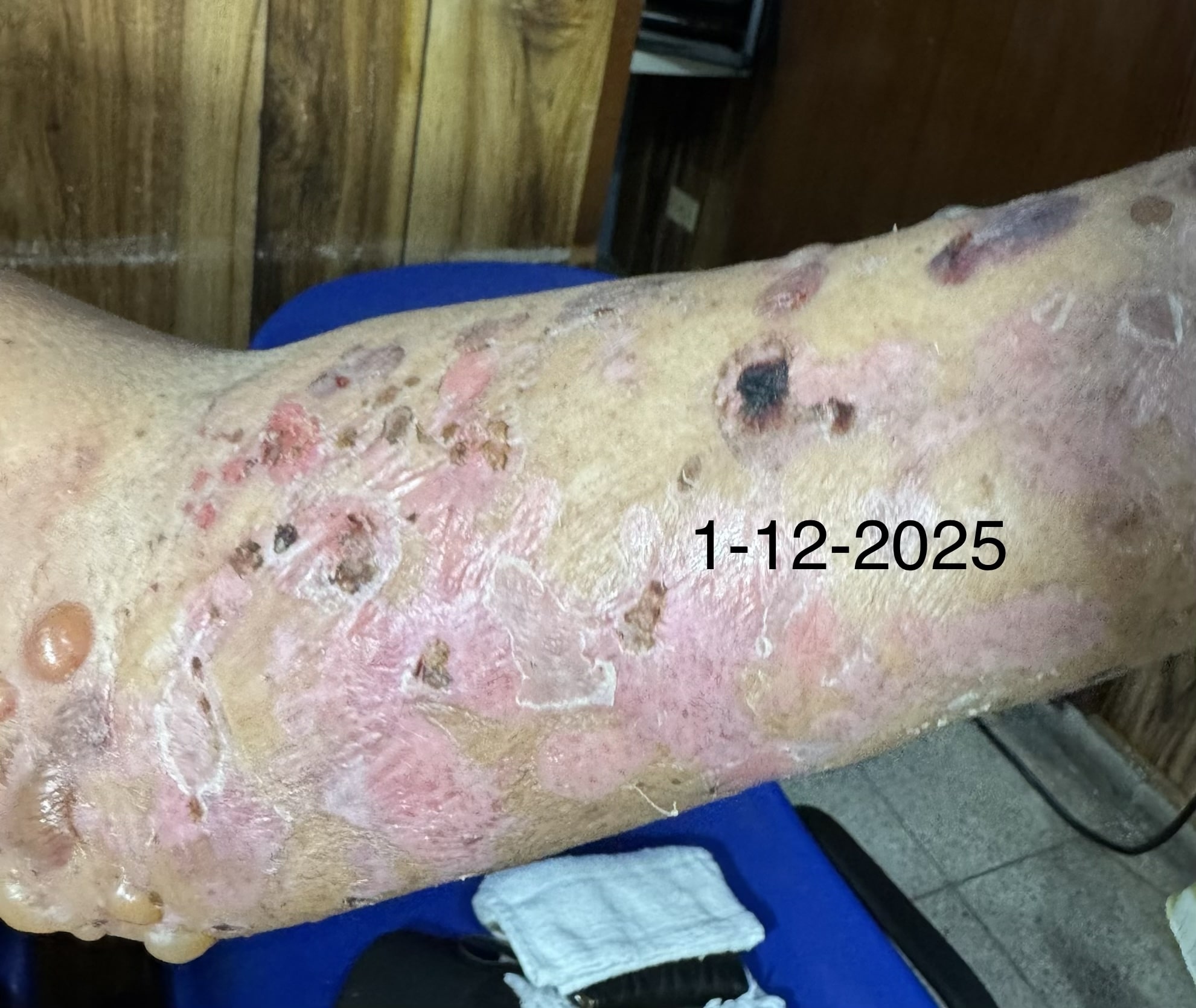 PENFIGOIDE AMPOLLOSO