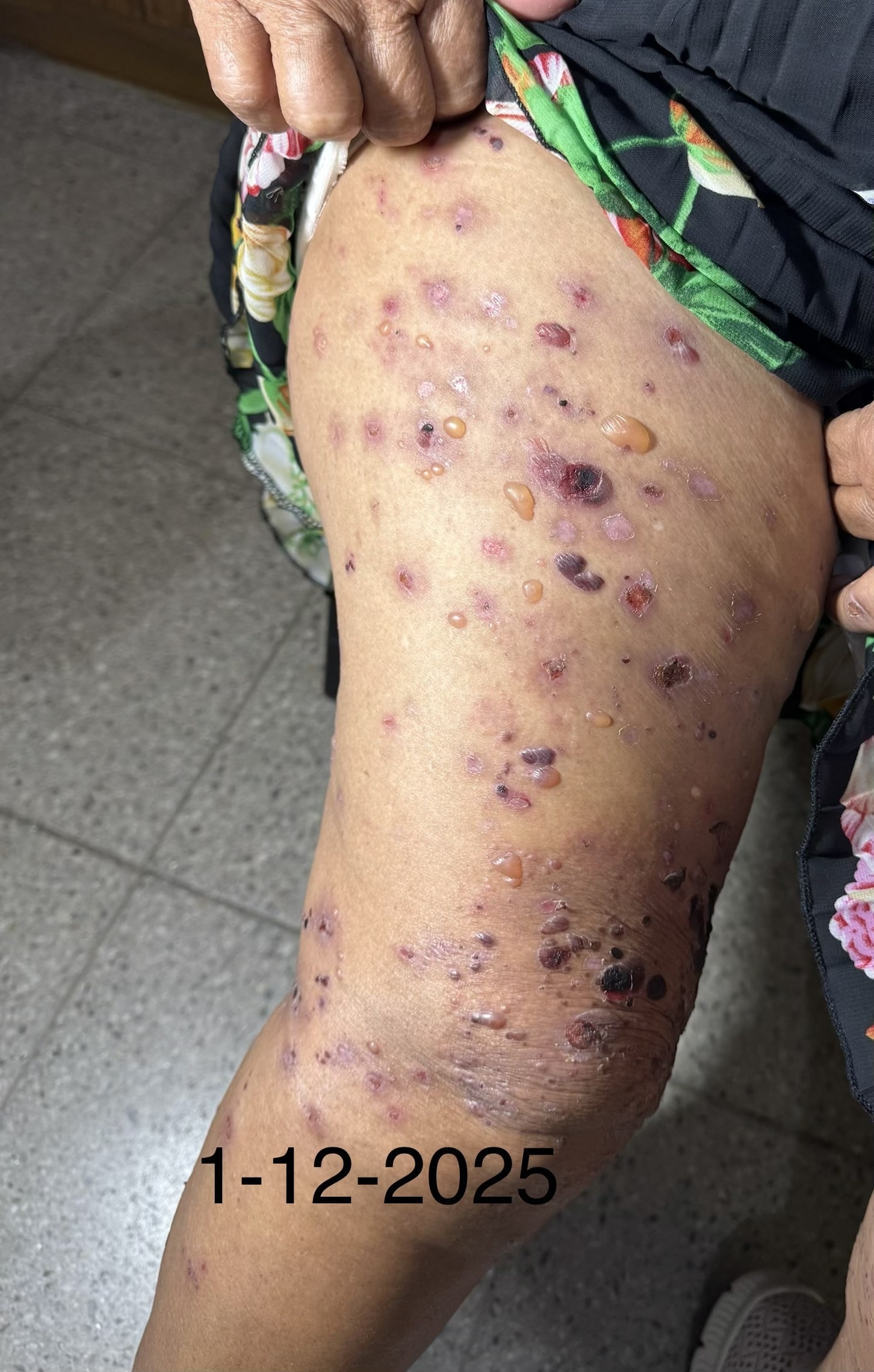 PENFIGOIDE AMPOLLOSO