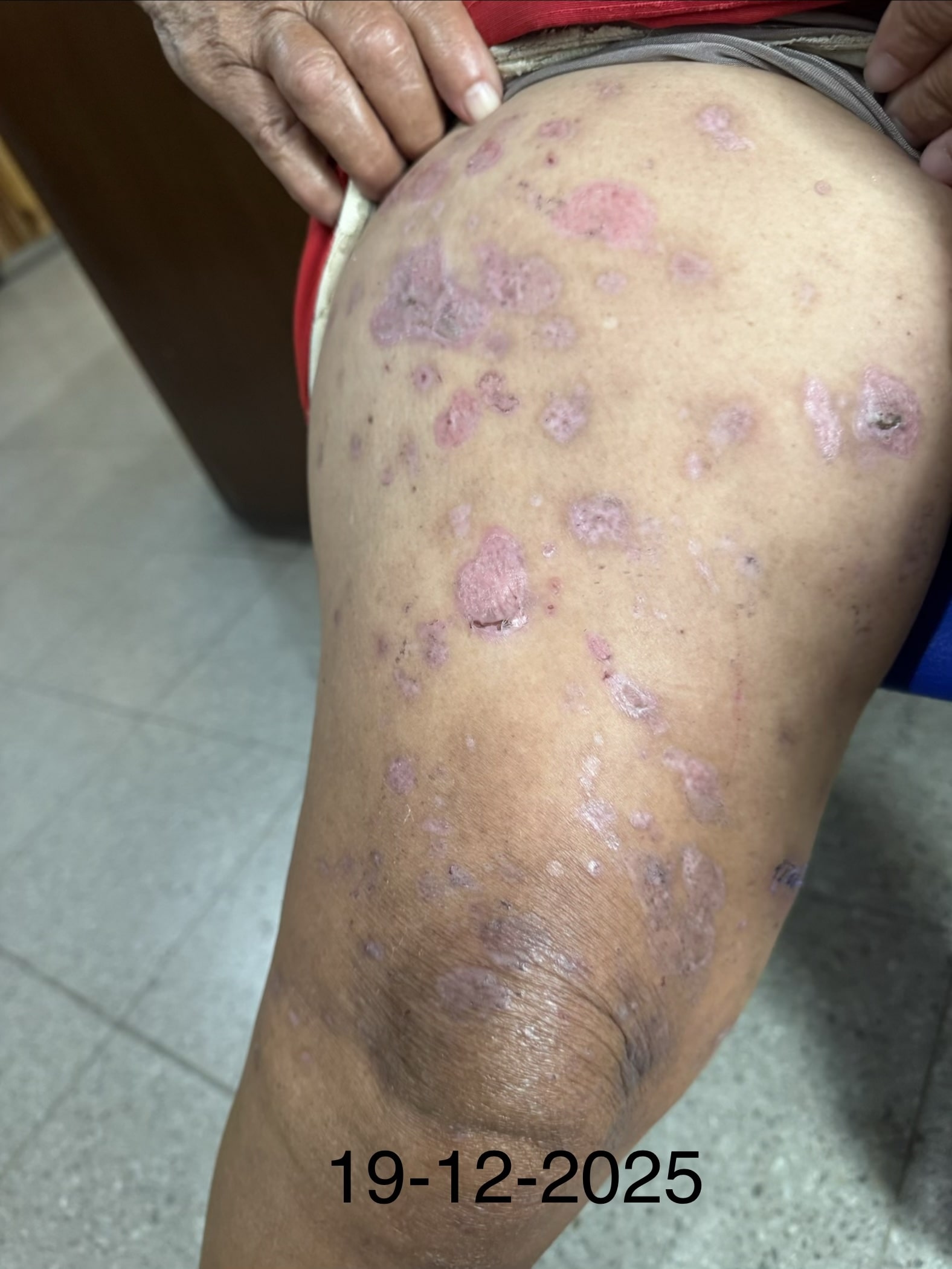 PENFIGOIDE AMPOLLOSO