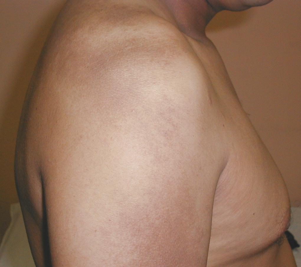 DEERMATOSIS CENICIENTA