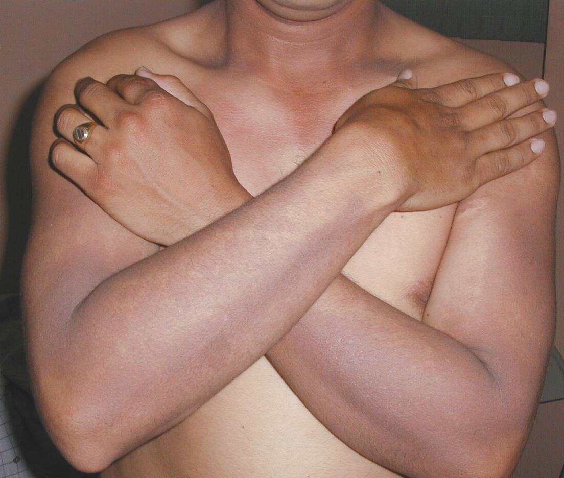 DEERMATOSIS CENICIENTA