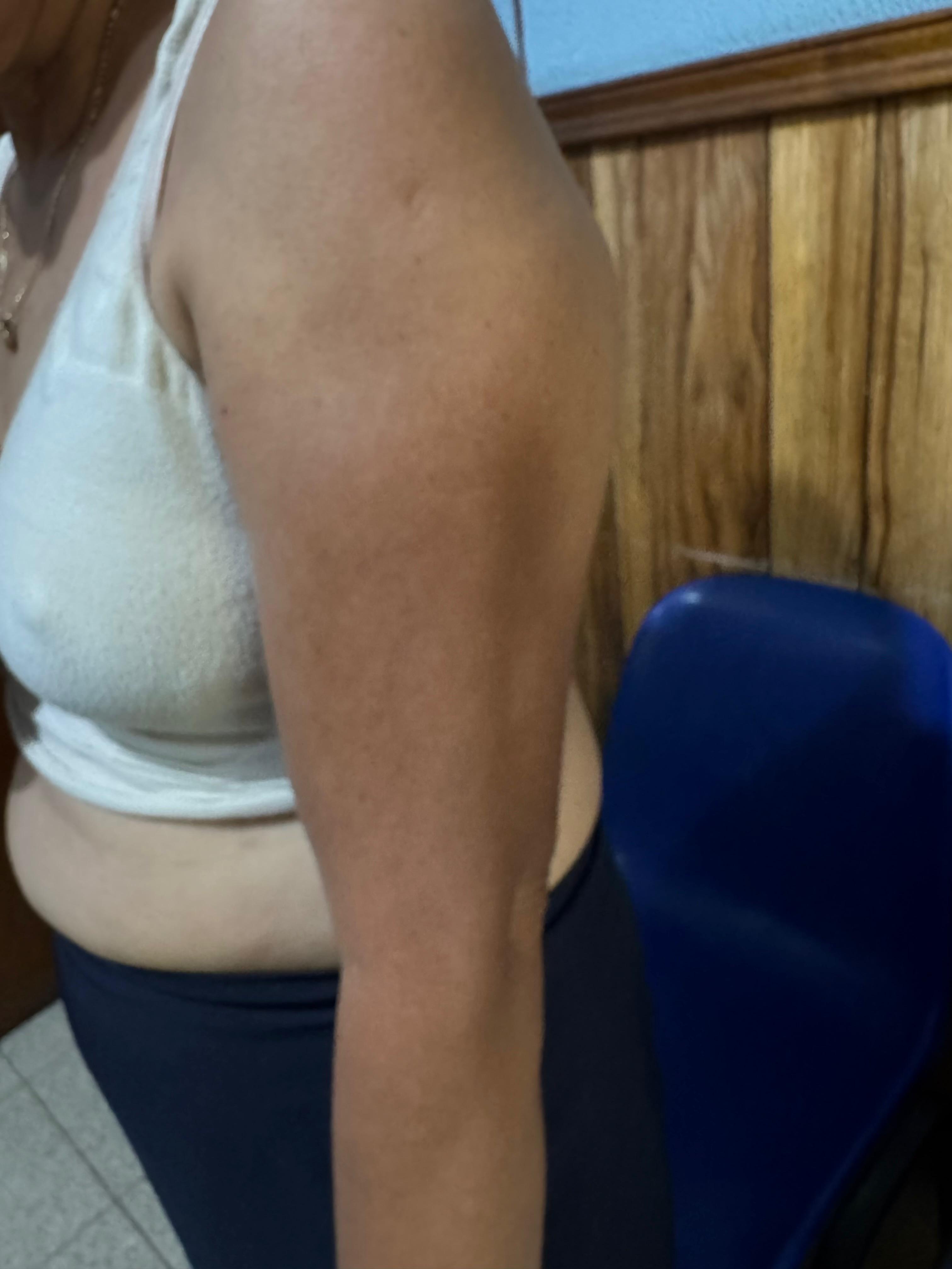 DERMATOSIS CENICIENTA