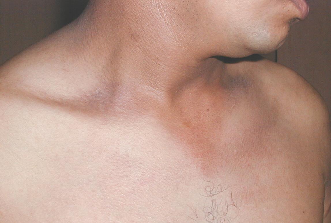 HIPERCROMIA POR FRICCION