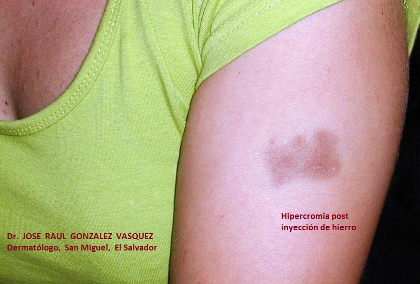 HIPERCROMIA - HIERRO INTRAMUSCULAR