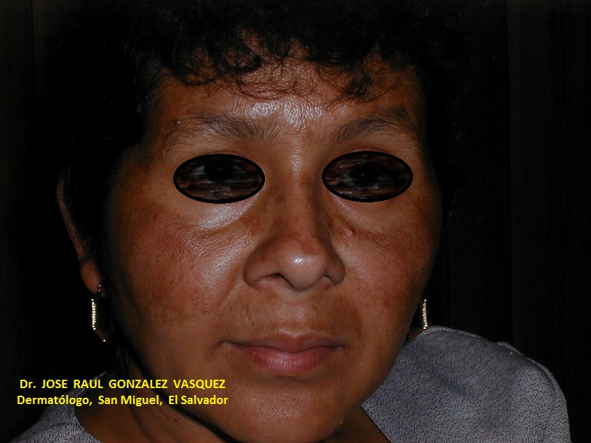 MELASMA