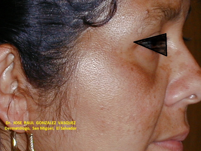 MELASMA