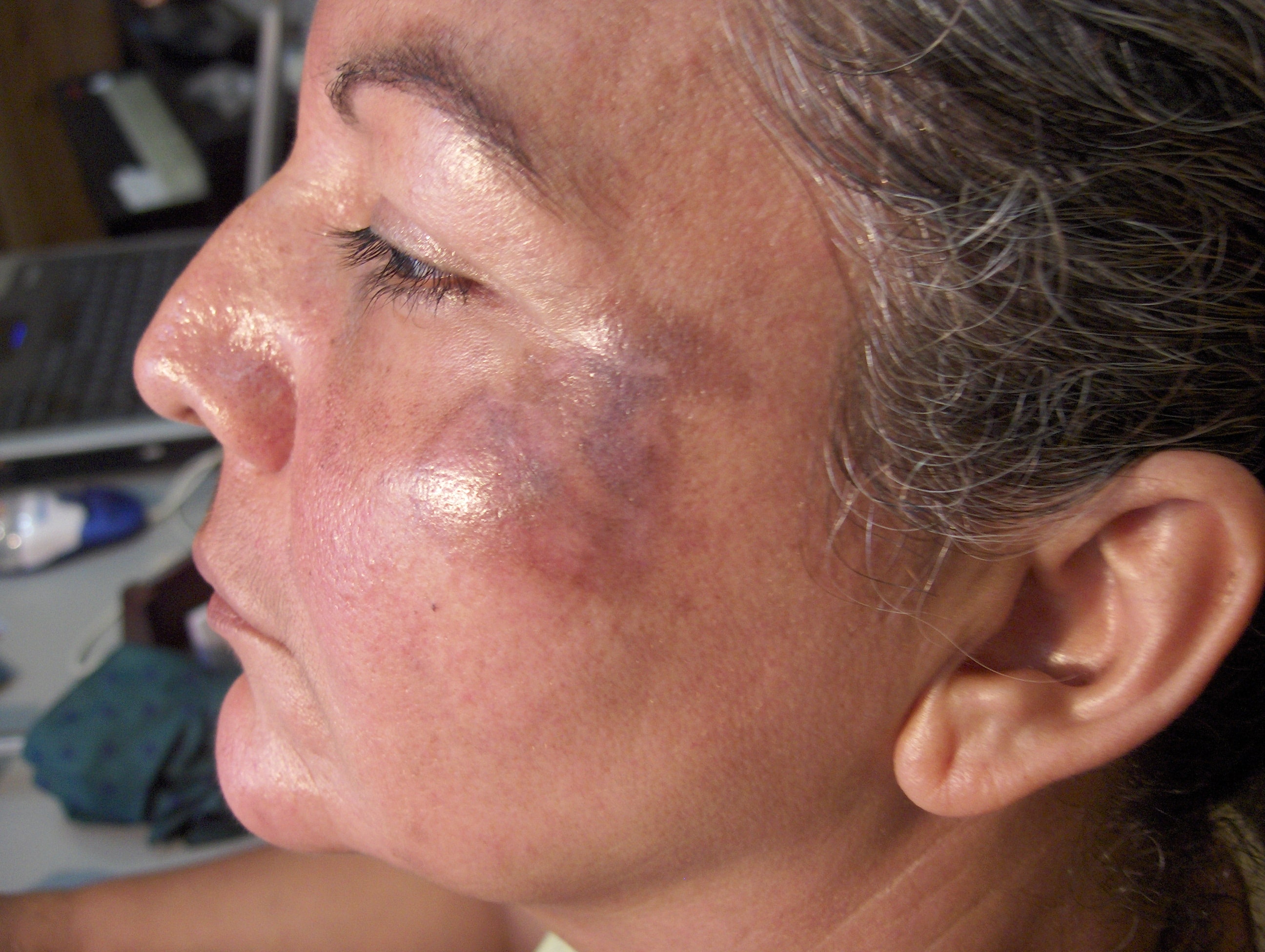 OCRONOSIS - HIDROQUINONA