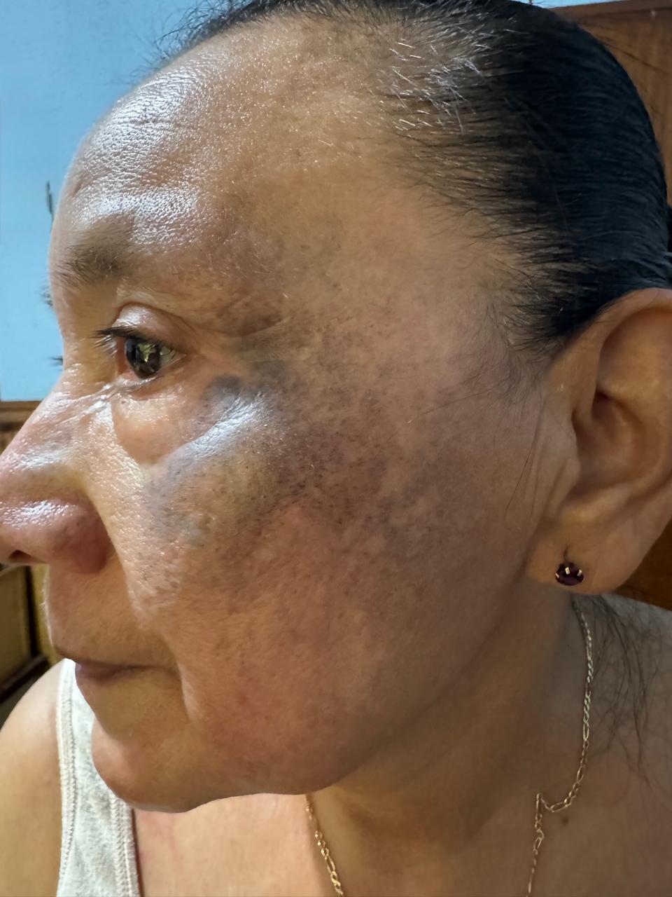 OCRONOSIS - HIDROQUINONA