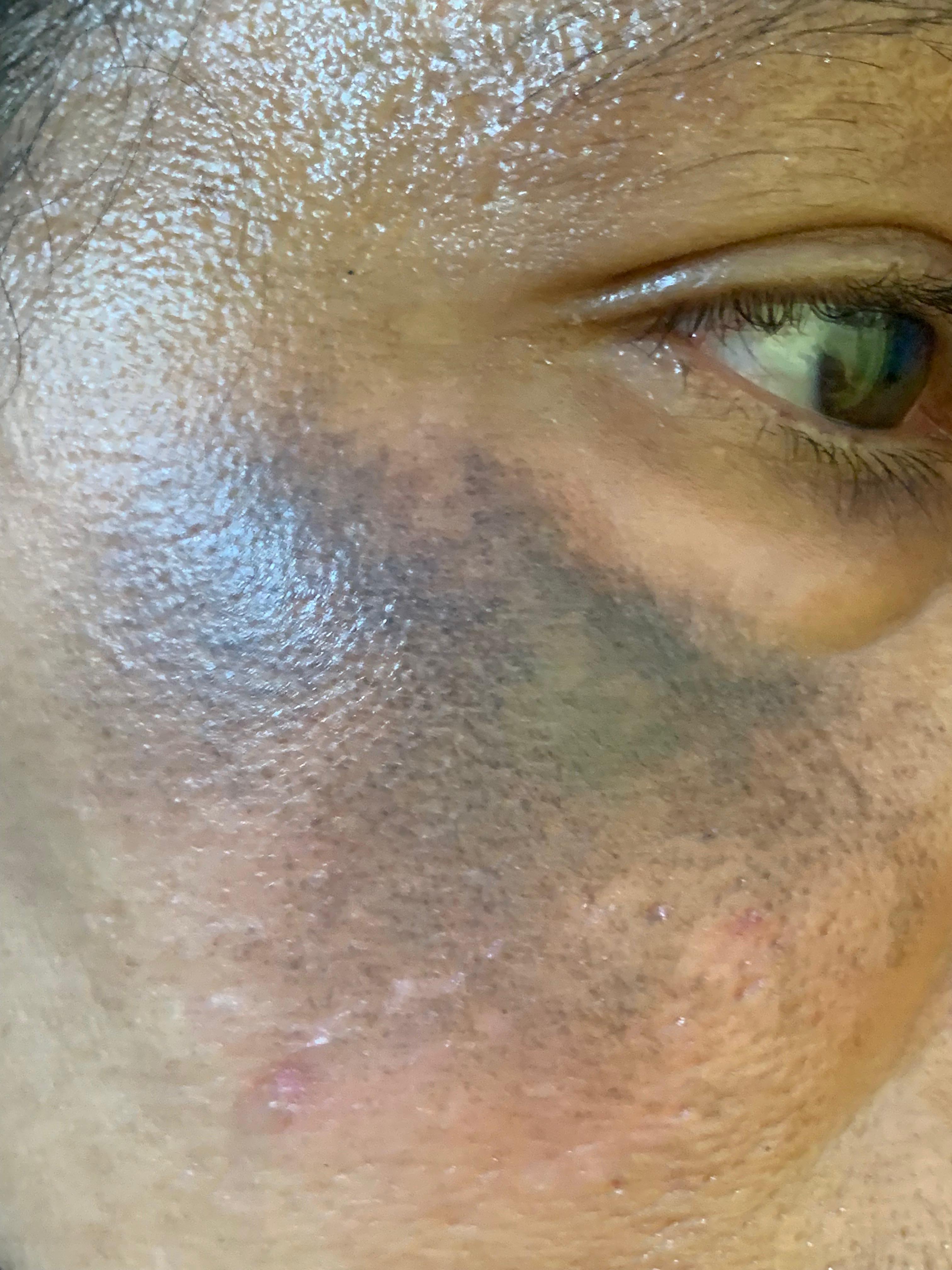 OCRONOSIS - HIDROQUINONA