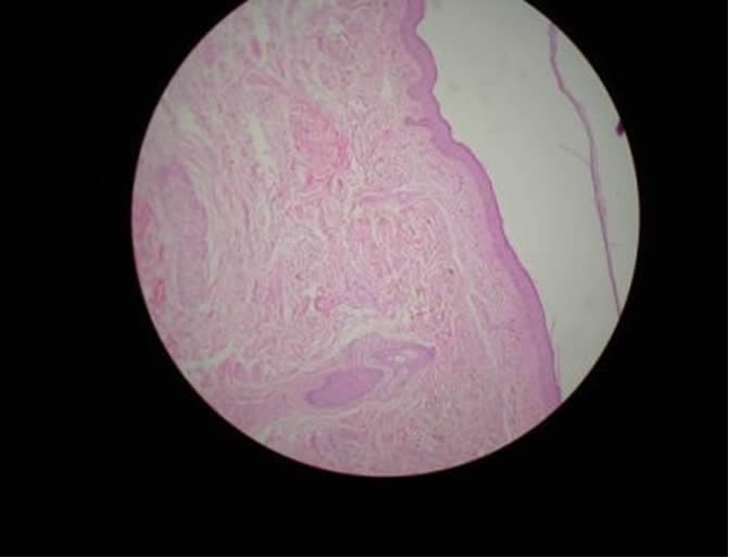 OCRONOSIS - HISTOPATOLOGIA - DR. PIQUERO