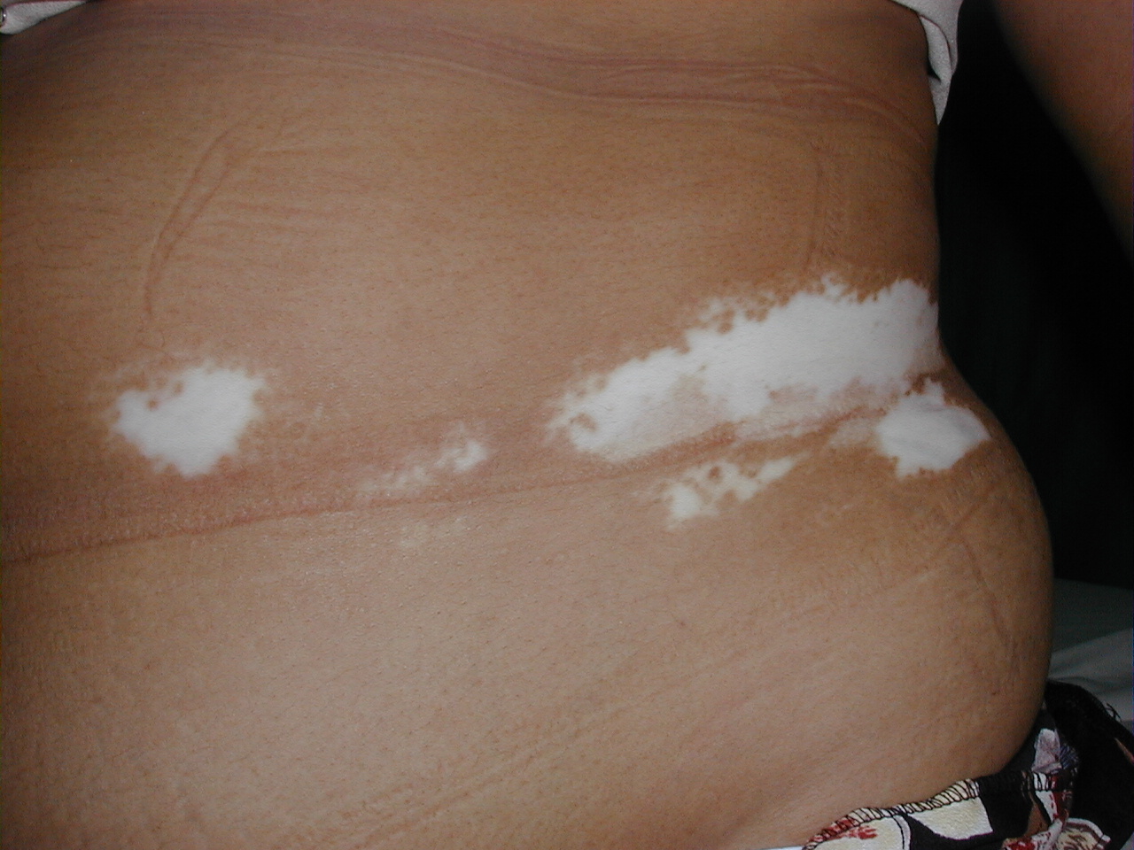 VITILIGO