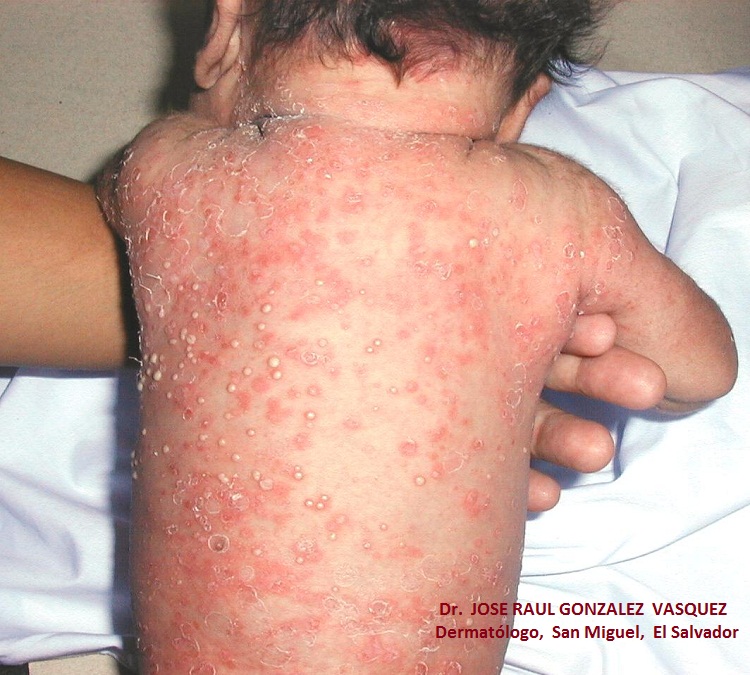 ESCABIOSIS - IMPETIGO