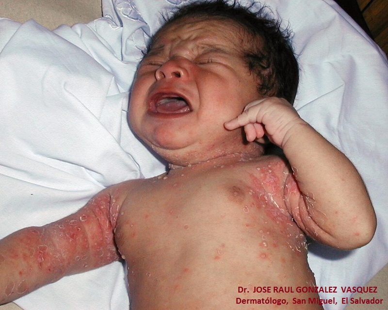 ESCABIOSIS - IMPETIGO