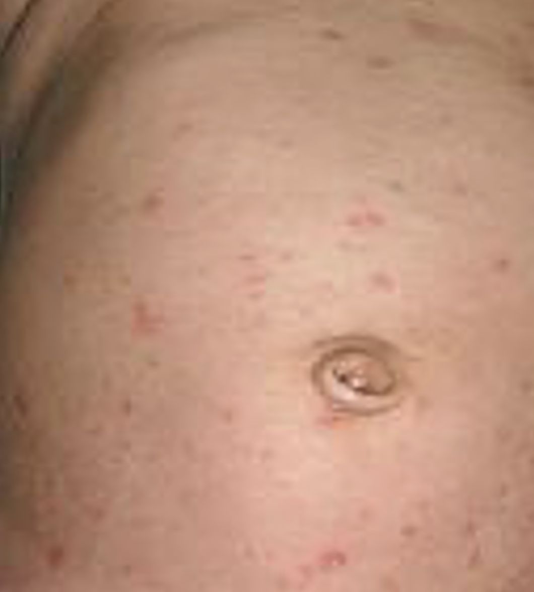 ESCABIOSIS EN NIÑOS