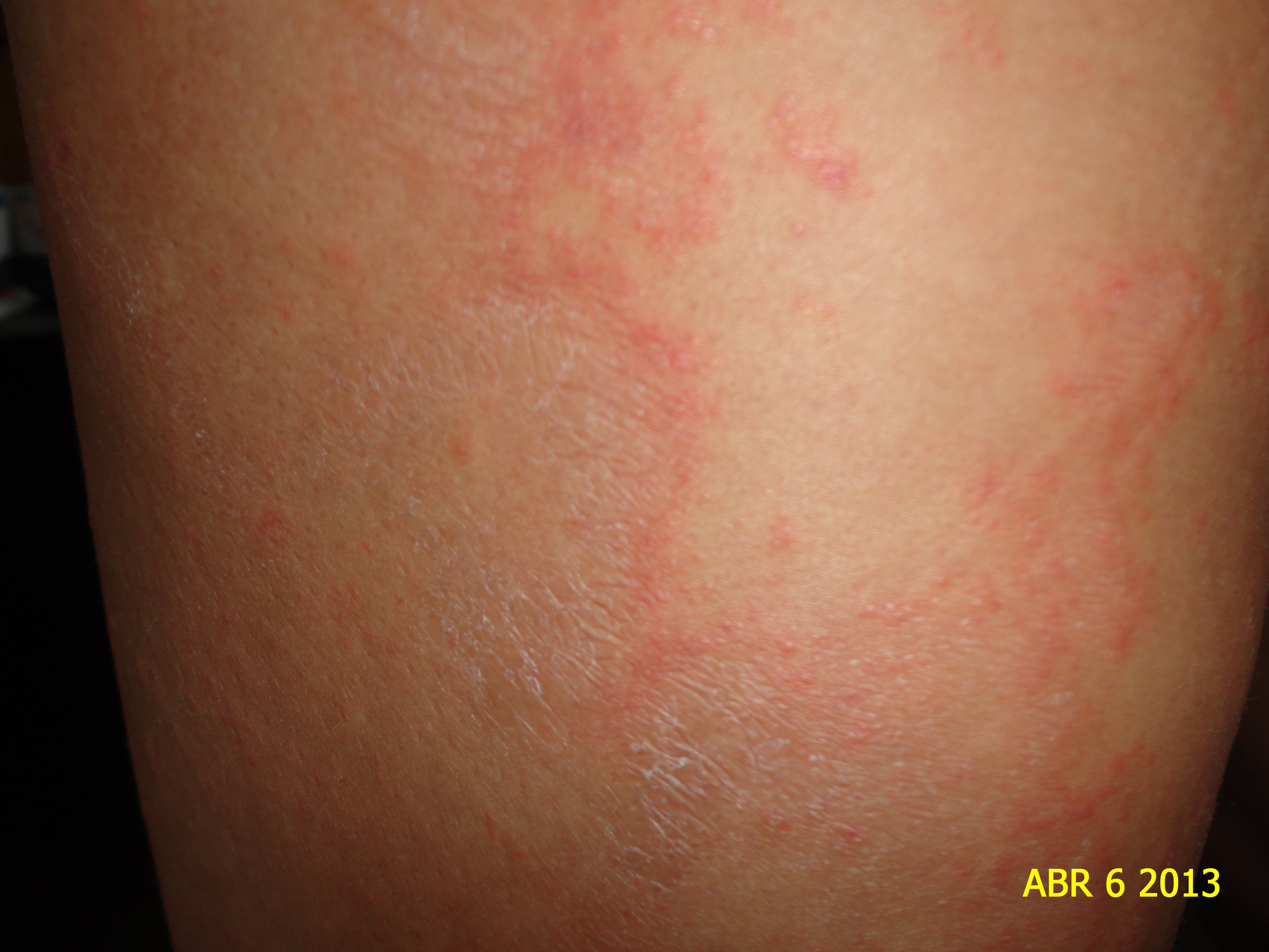 LARVA MIGRANS EN MUSLO