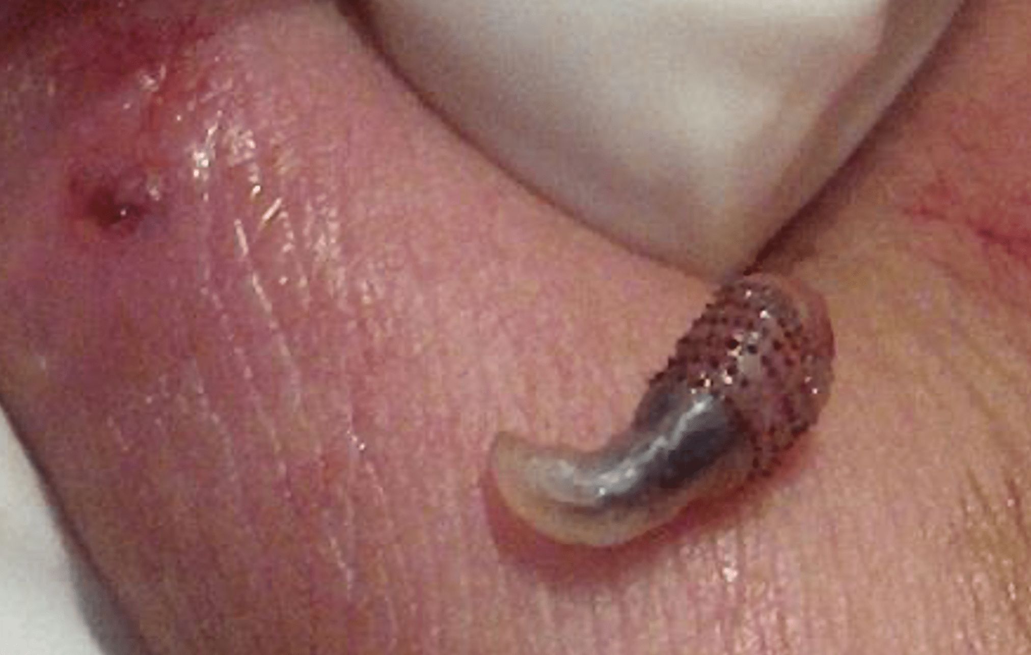 TORSALO - EXTRACCION DE LARVA