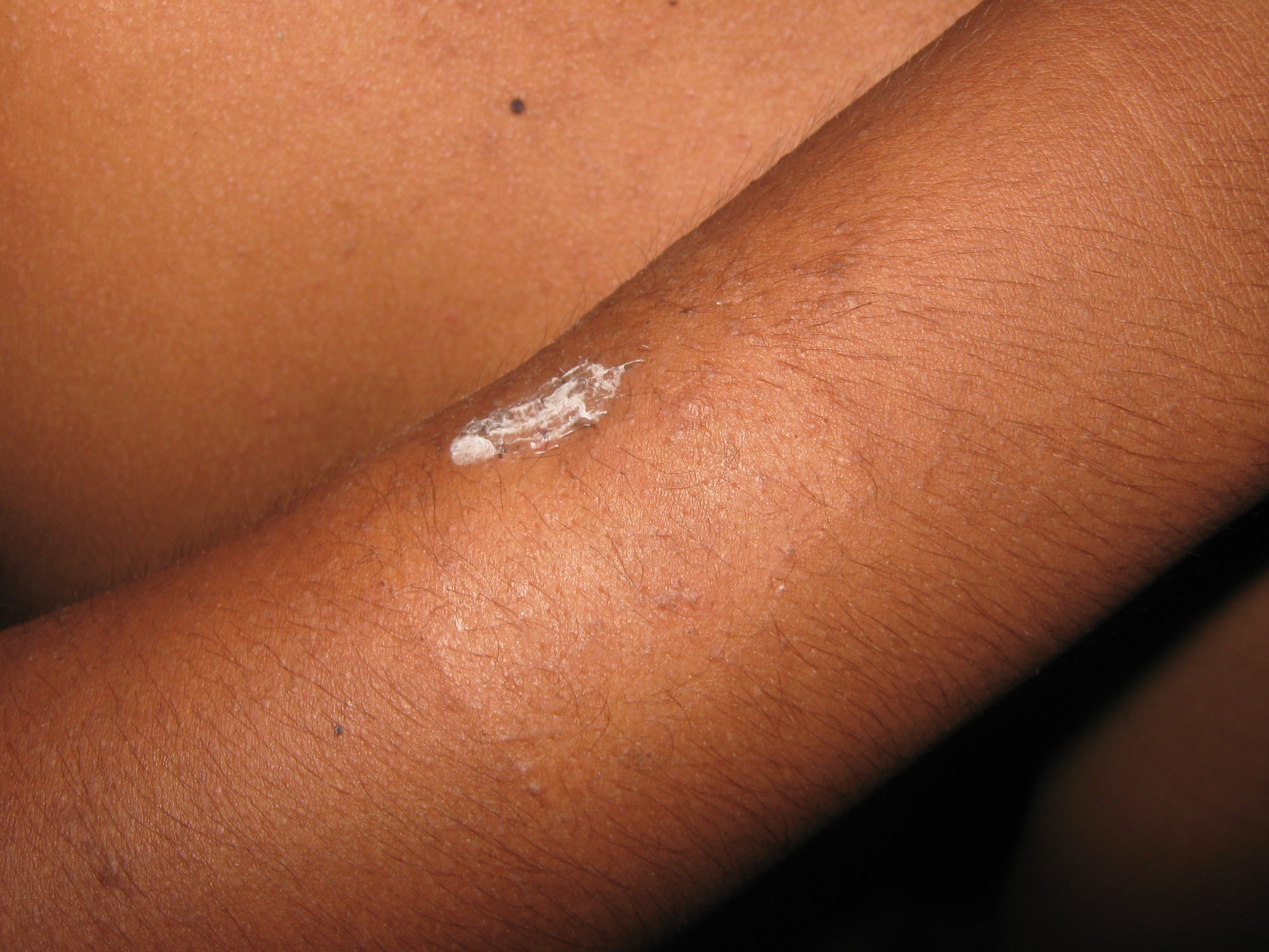 ENFEREMEDAD DE DARIER