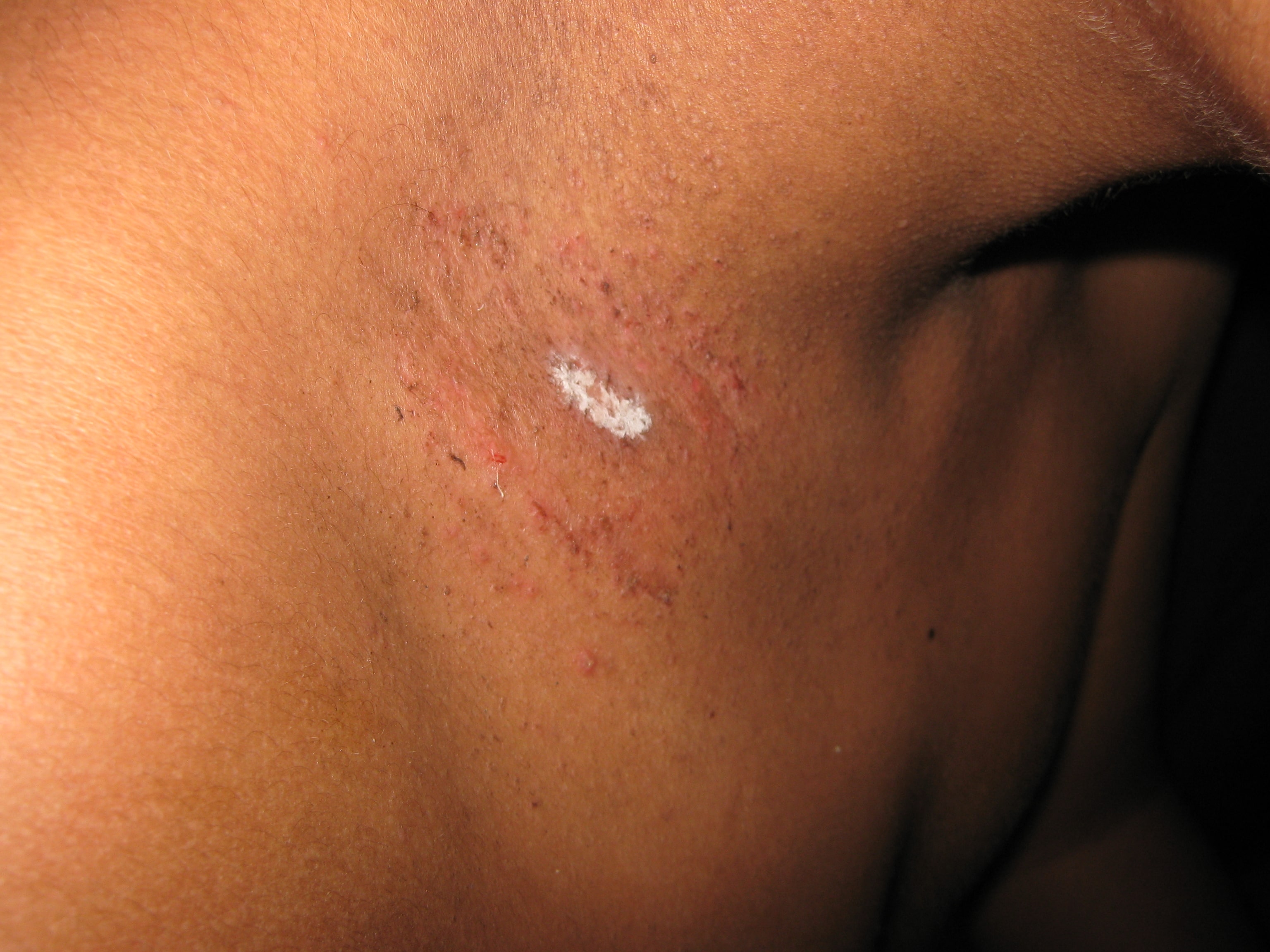 ENFEREMEDAD DE DARIER