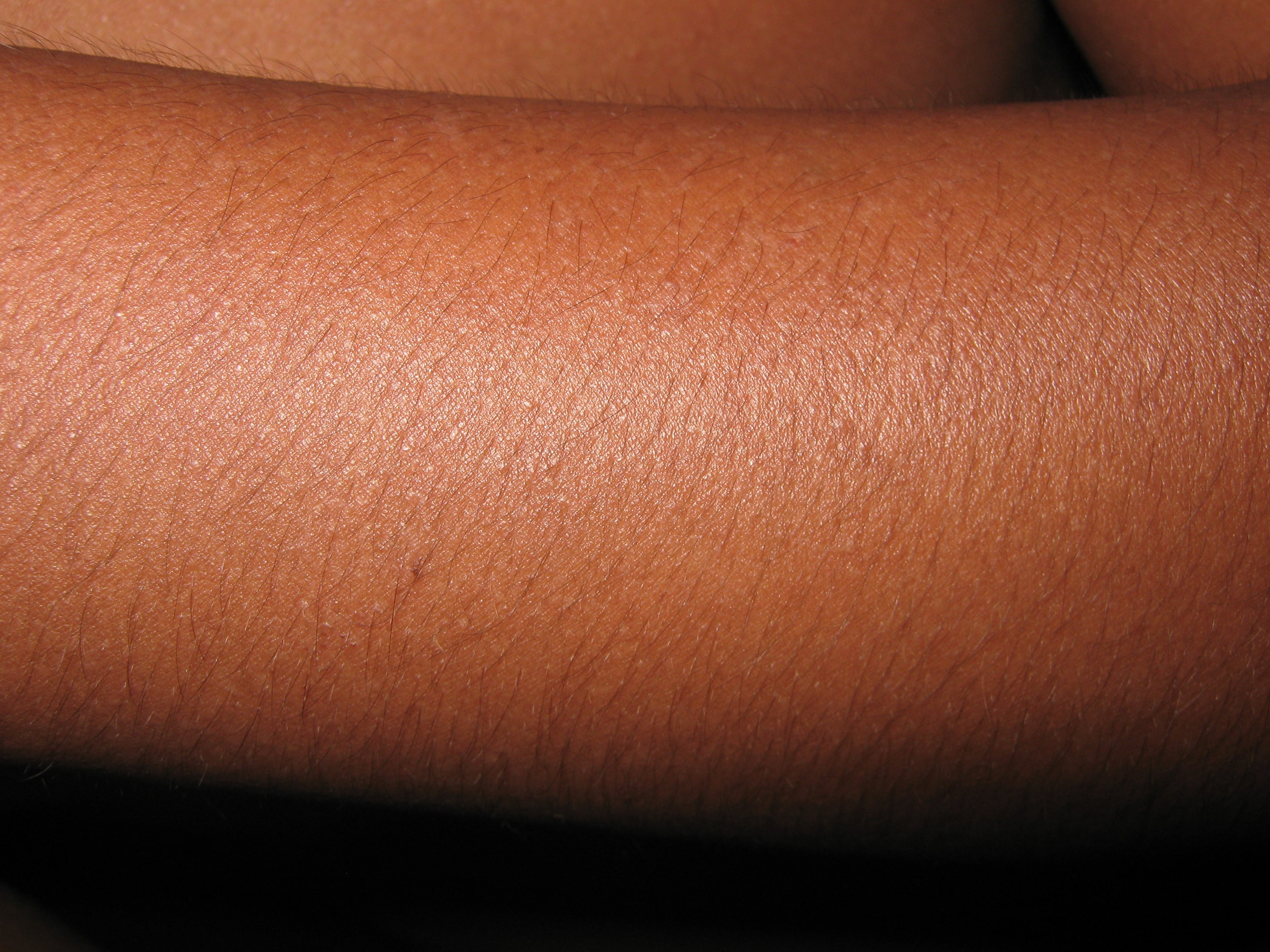 ENFEREMEDAD DE DARIER