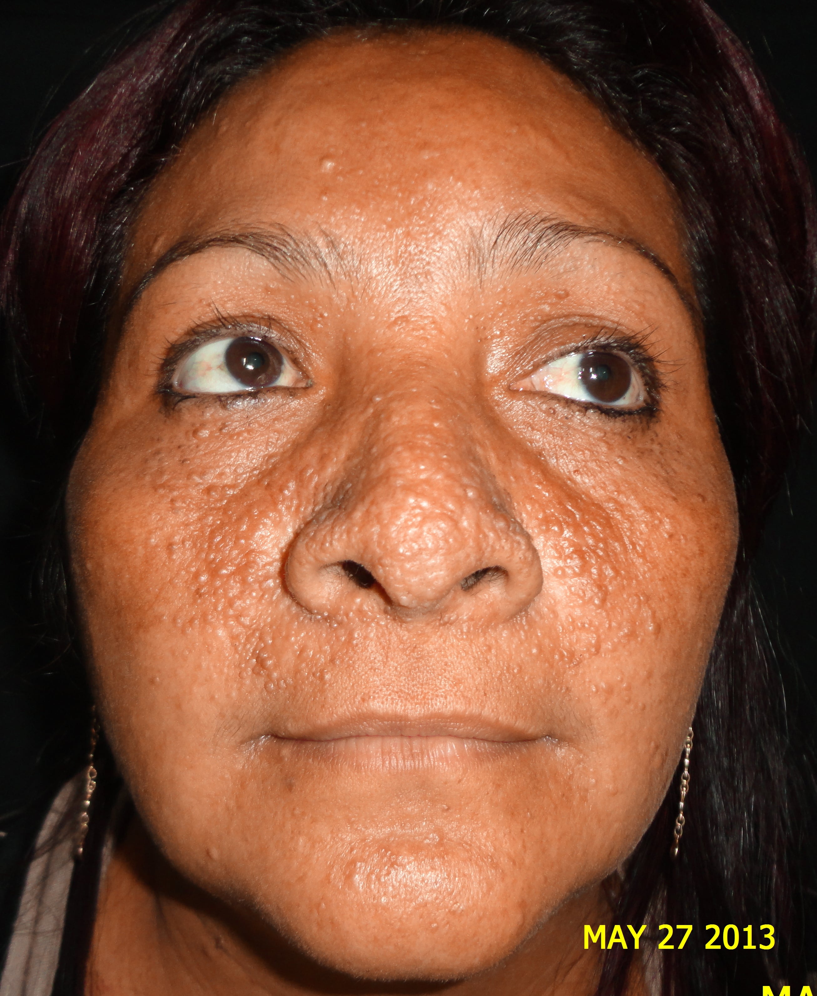 ESCLEROSIS TUBEROSA - ANGIOFIBROMAS