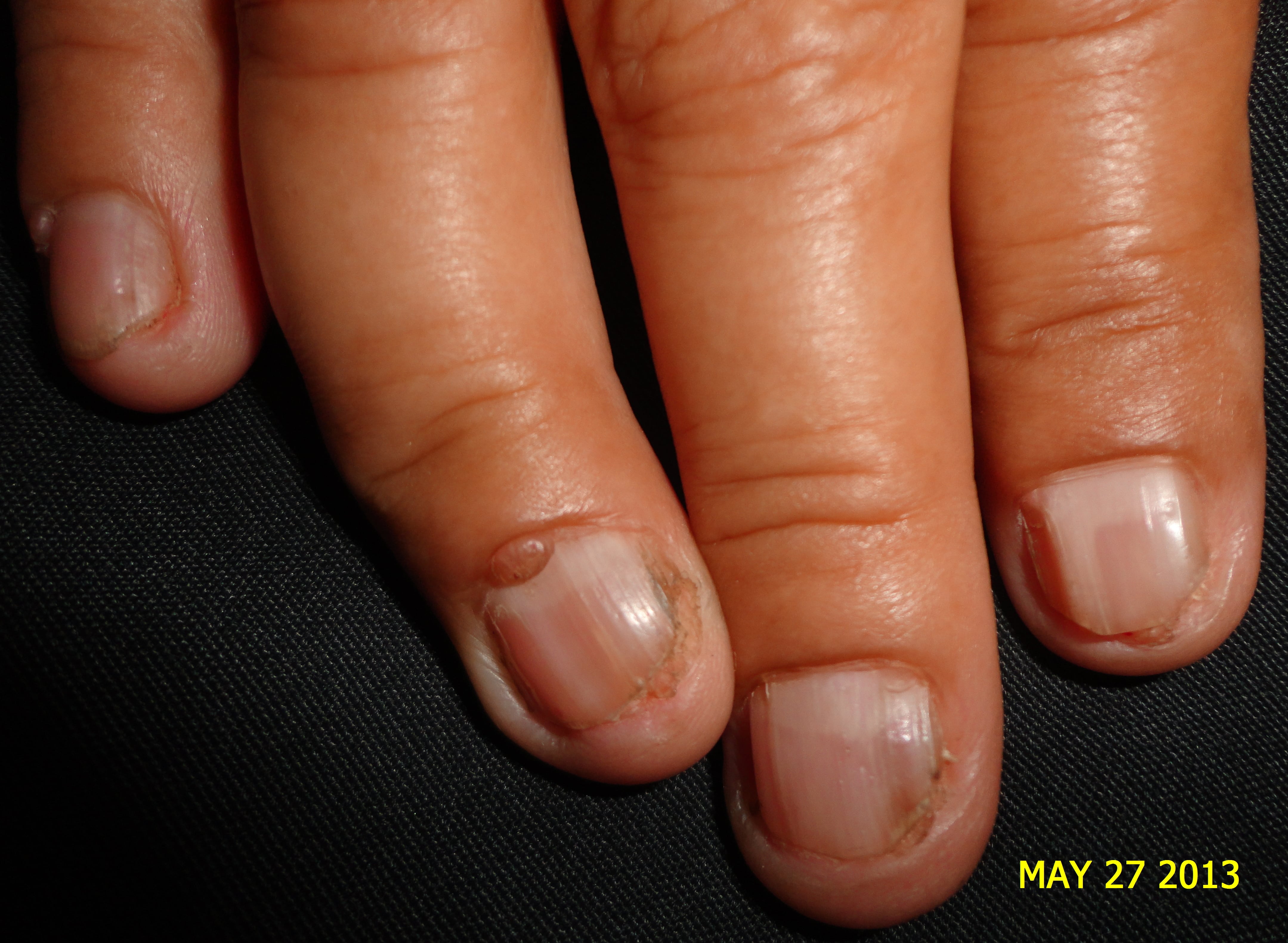 ESCLEROSIS TUBEROSA - FIBROMAS ó TUMOR DE KOENEN