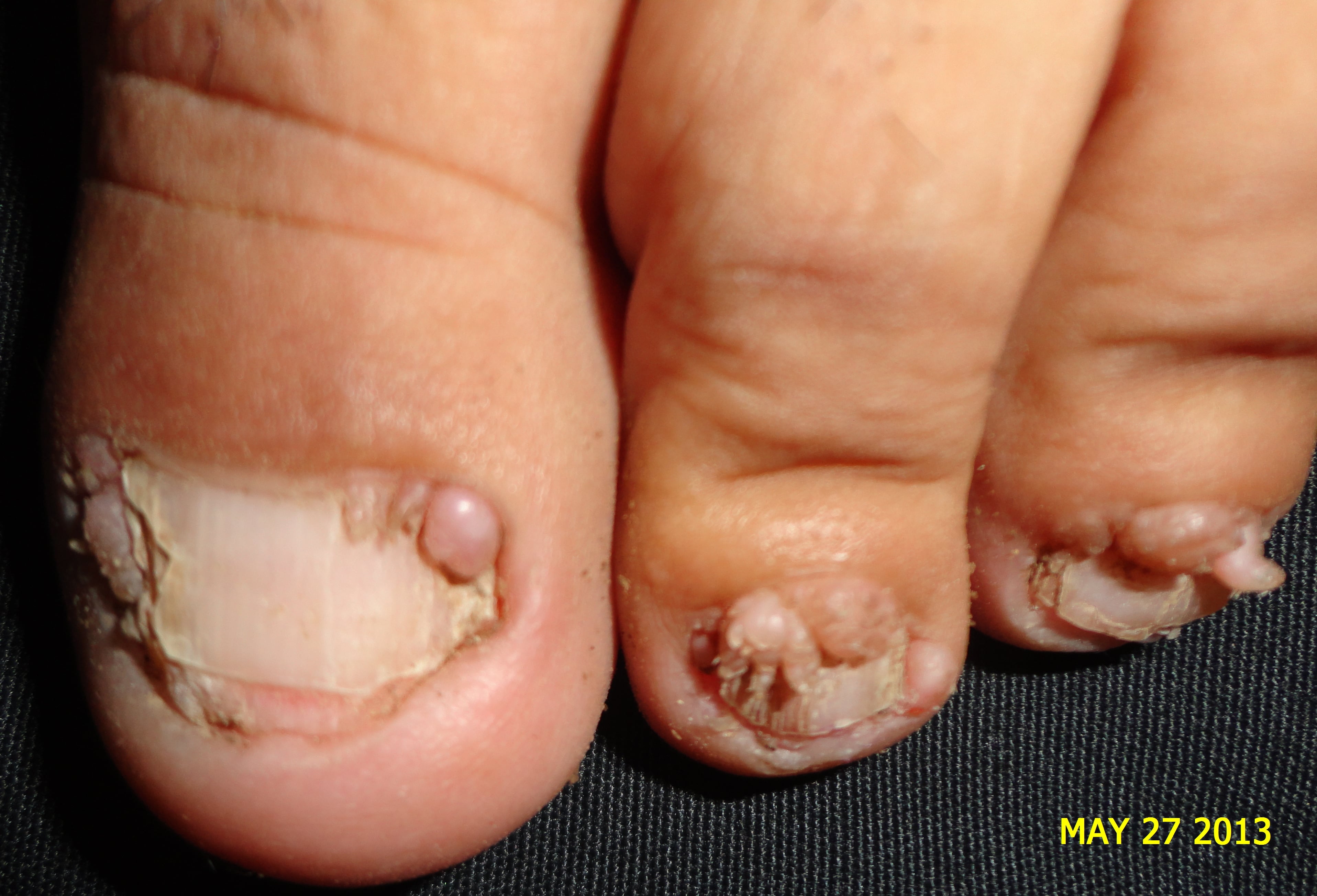 ESCLEROSIS TUBEROSA - FIBROMAS ó TUMOR DE KOENEN