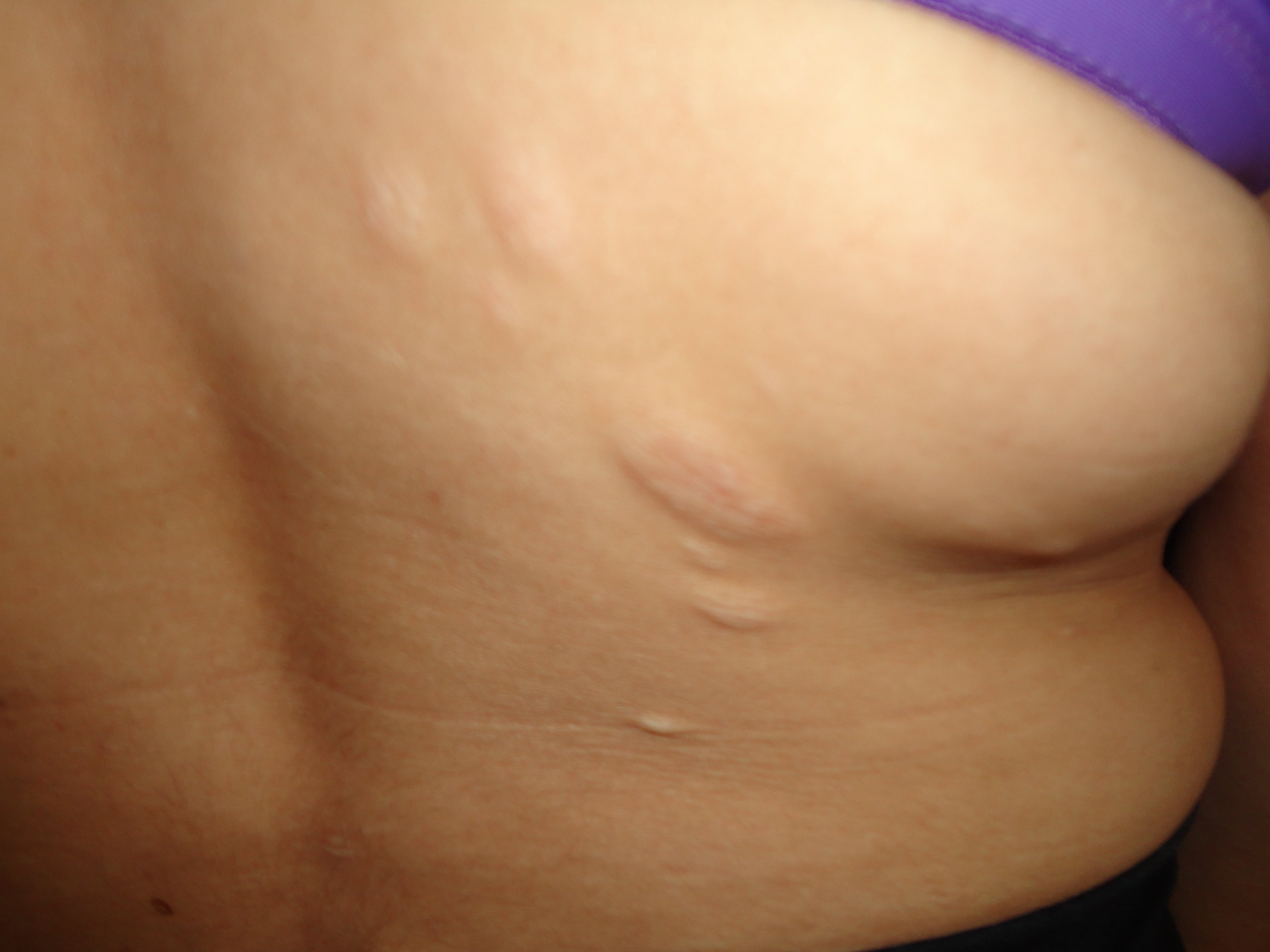 ESCLEROSIS TUBEROSA - PIEL CHAGRIN