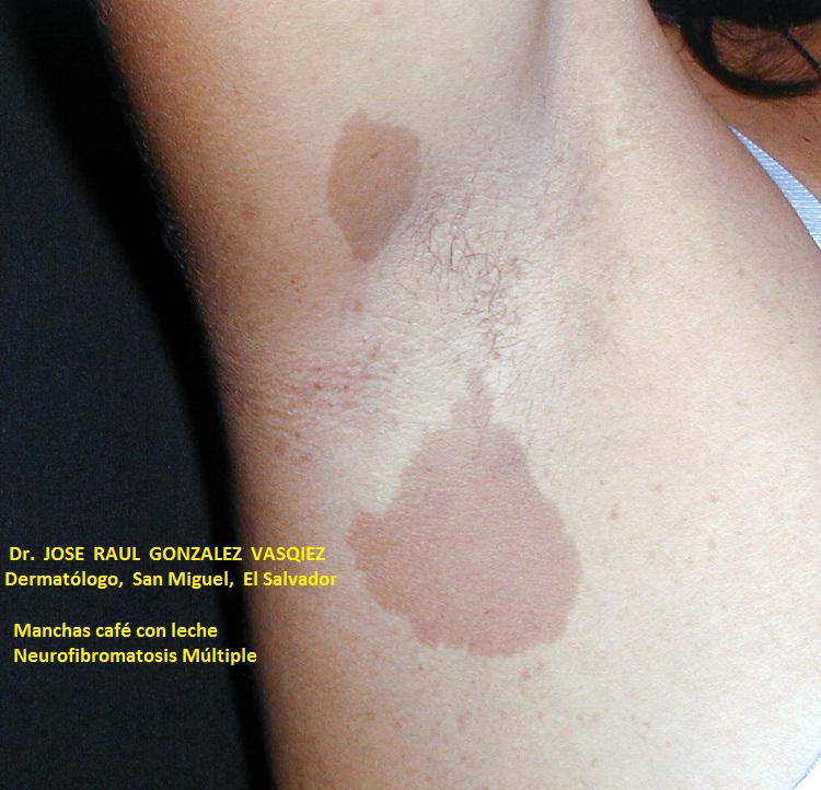 NEUROFIBROMATOSIS MULTIPLE - MANCHAS CAFE CON LECHE