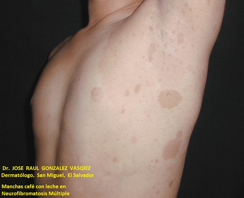 NEUROFIBROMATOSIS MULTIPLE - MANCHAS CAFE CON LECHE