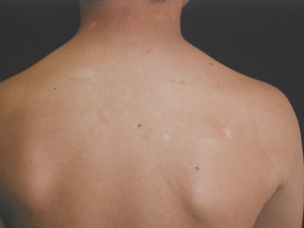 NEUROFIBROMATOSIS MULTIPLE - MANCHAS CAFE CON LECHE