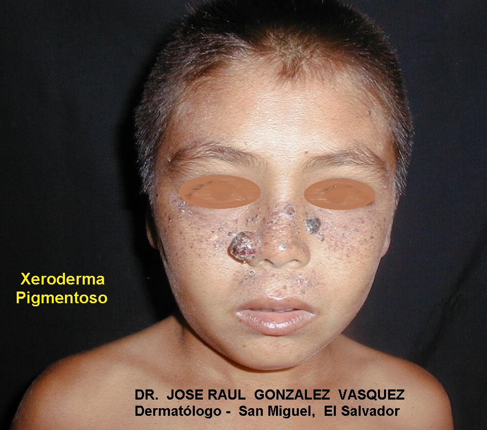 XERODERMA PIGMENTOSO