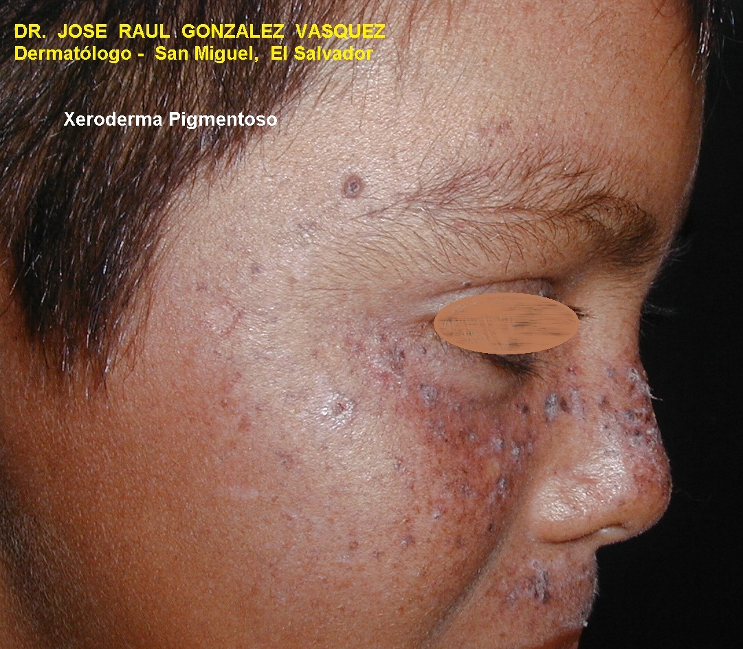 XERODERMA PIGMENTOSO
