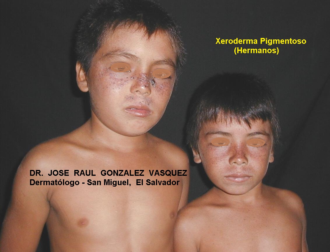 XERODERMA PIGMENTOSO - HERMANOS