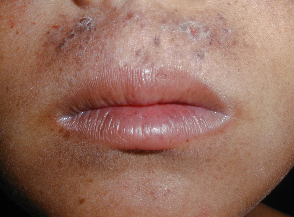 XERODERMA PIGMENTOSO - HERMANOS