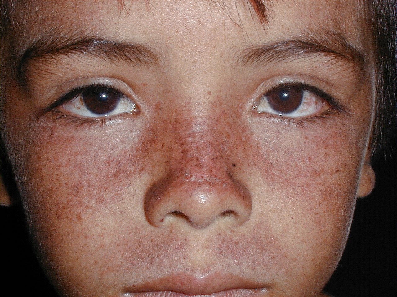 XERODERMA PIGMENTOSO - HERMANOS