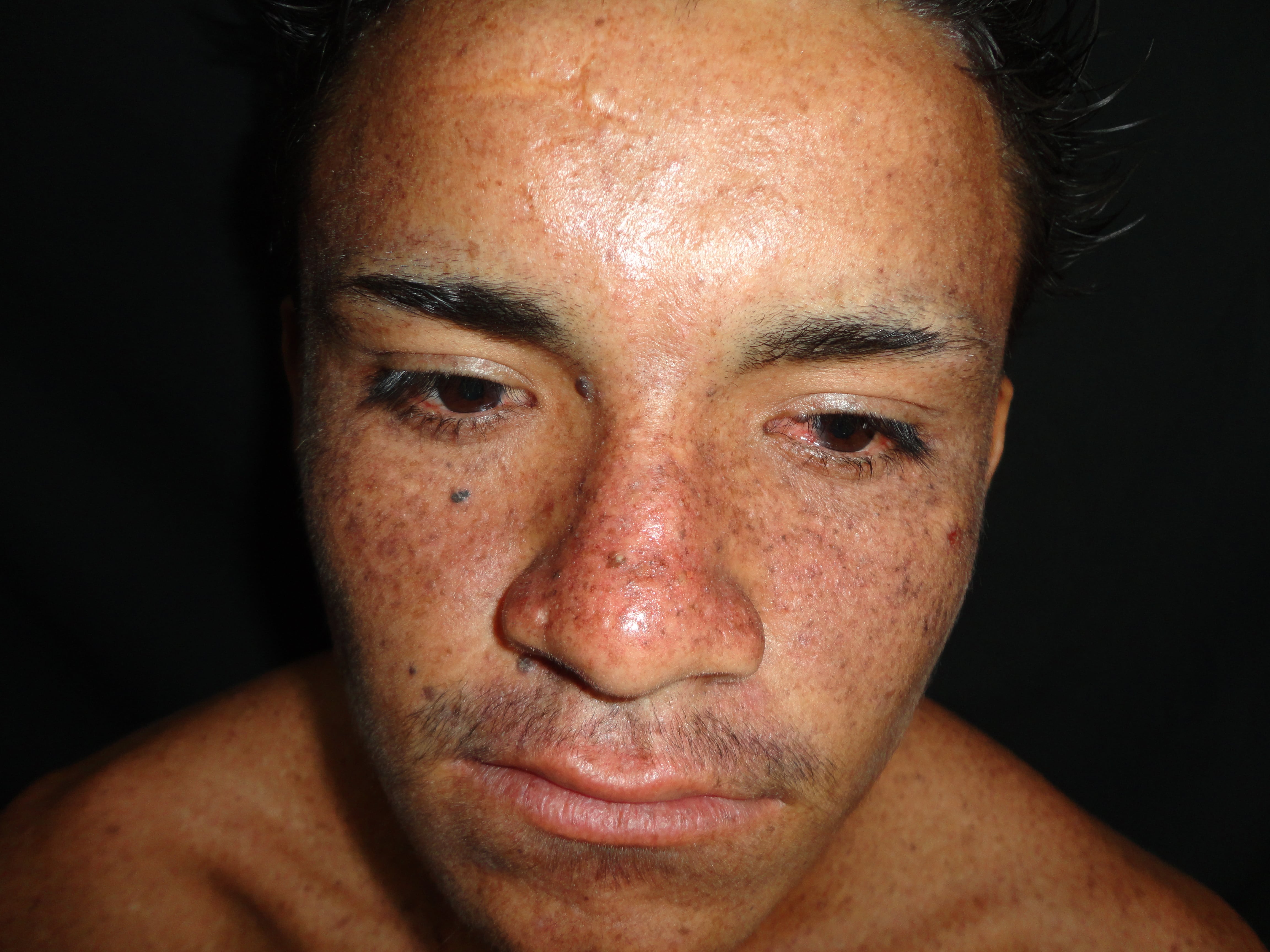 XERODERMA PIGMENTOSO