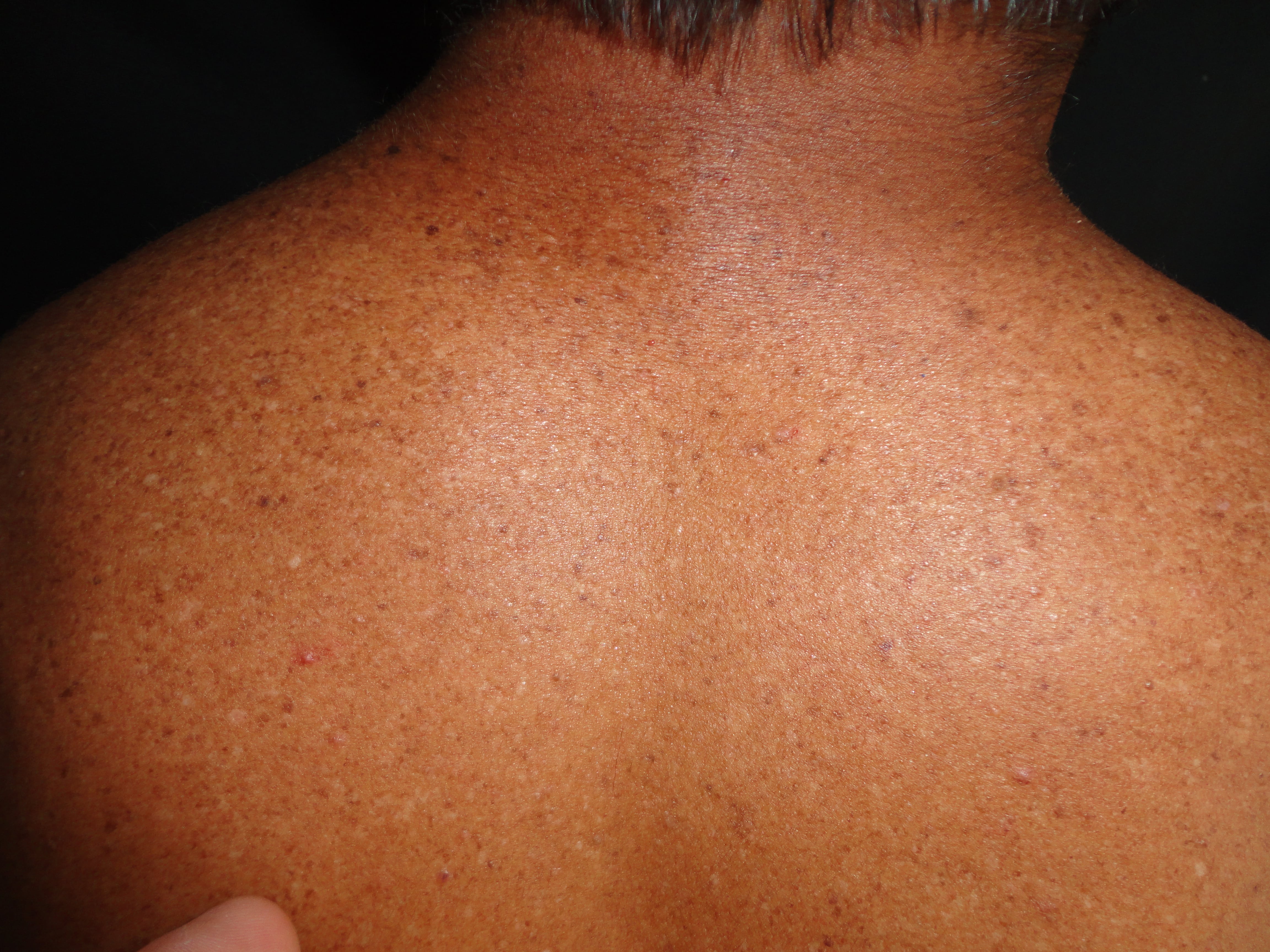 XERODERMA PIGMENTOSO
