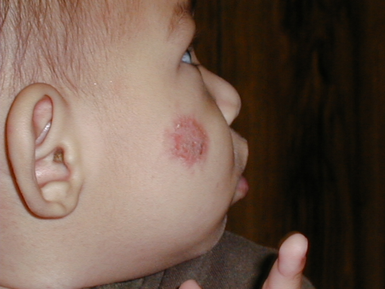 ECCEMA AGUDO - Numular