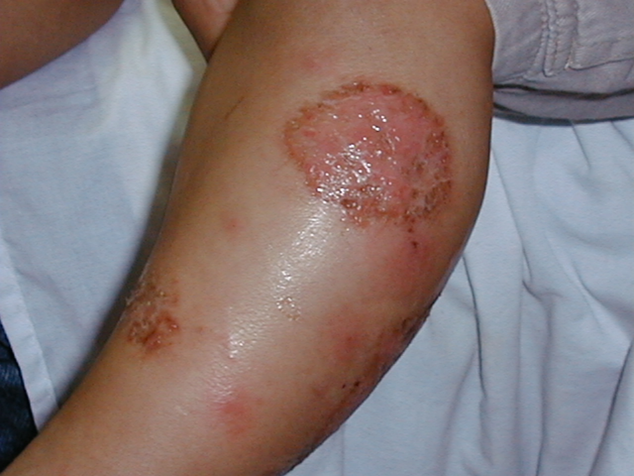 ECCEMA AGUDO - Numular