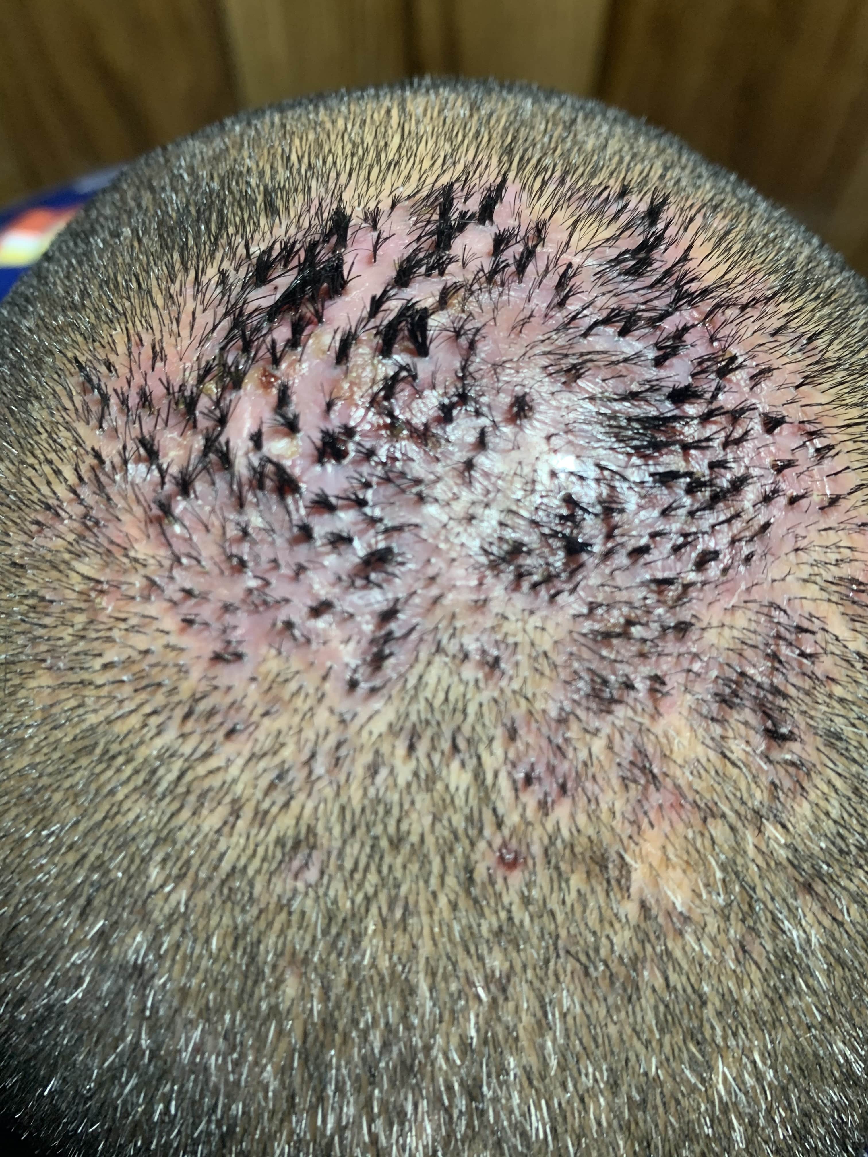 ALOPECIA CICATRIZAL - Foliculitis Decalvante