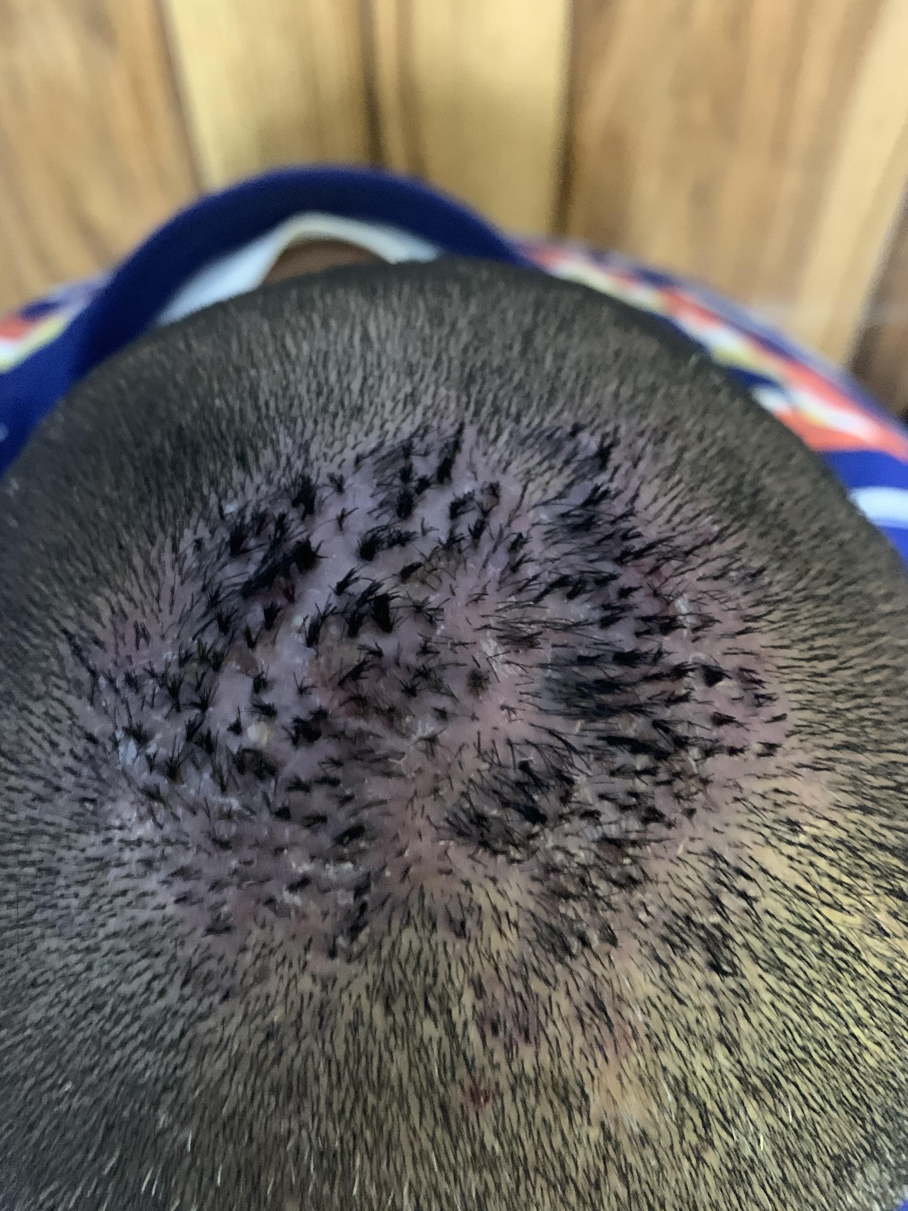 ALOPECIA CICATRIZAL - Foliculitis Decalvante