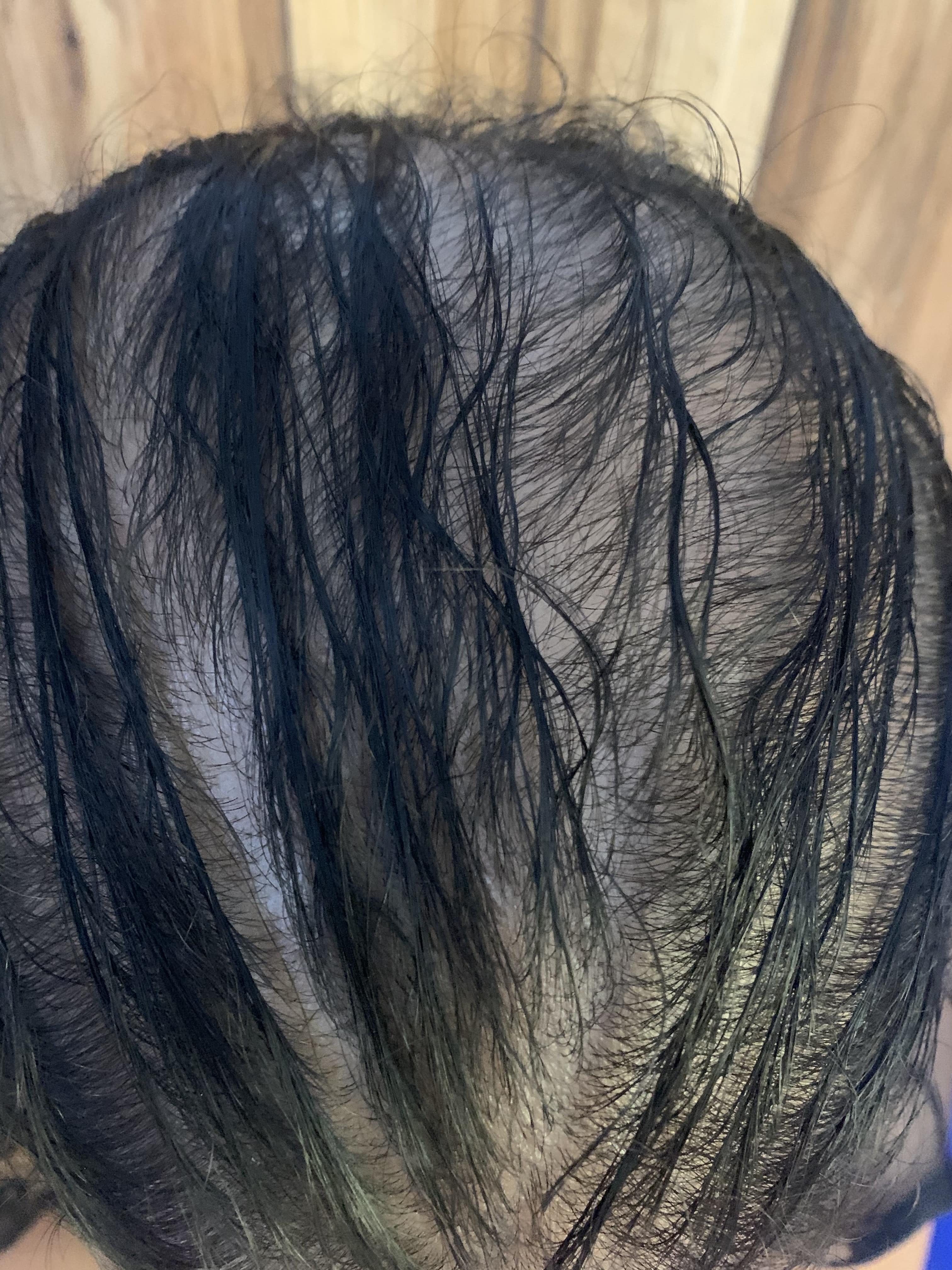 ALOPECIA ANDROGENETICA - Patrón femenino