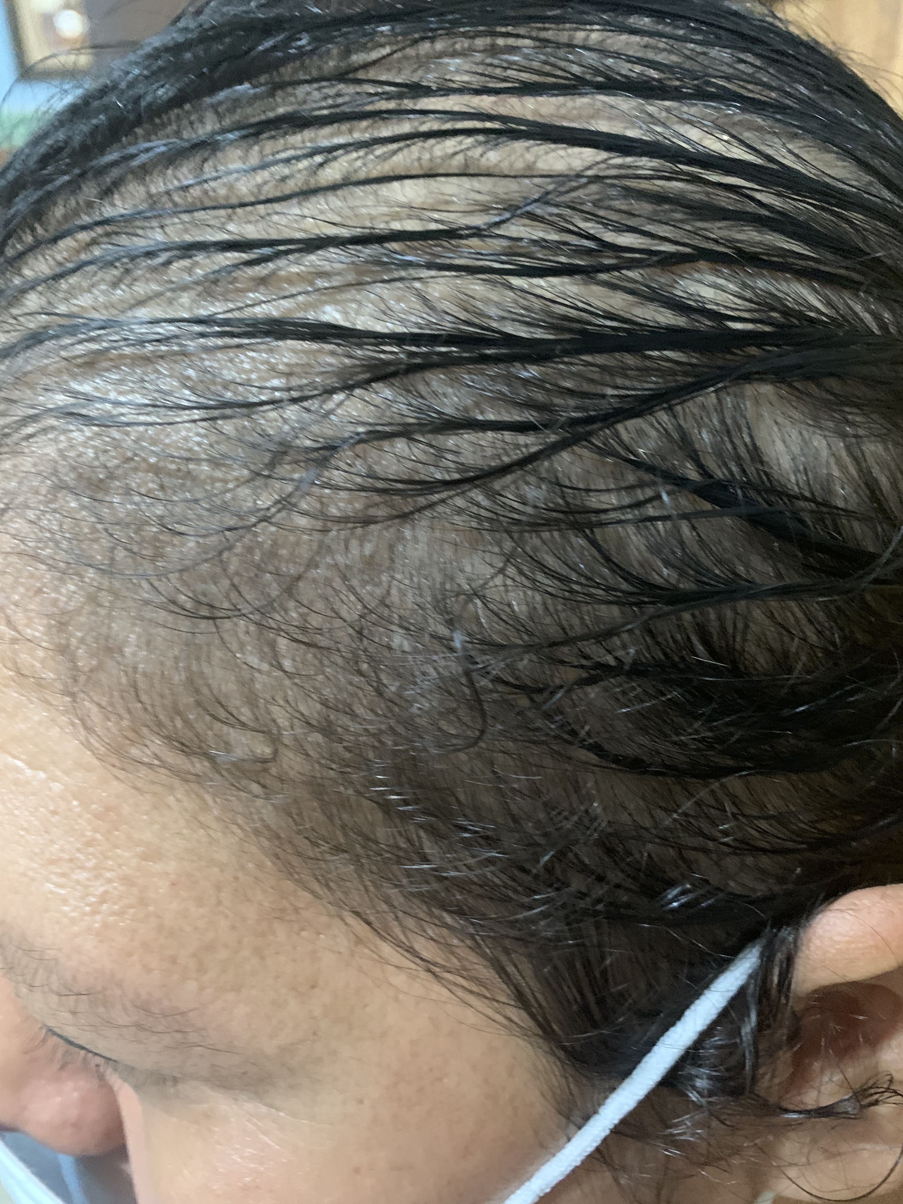 ALOPECIA ANDROGENETICA - Patrón femenino